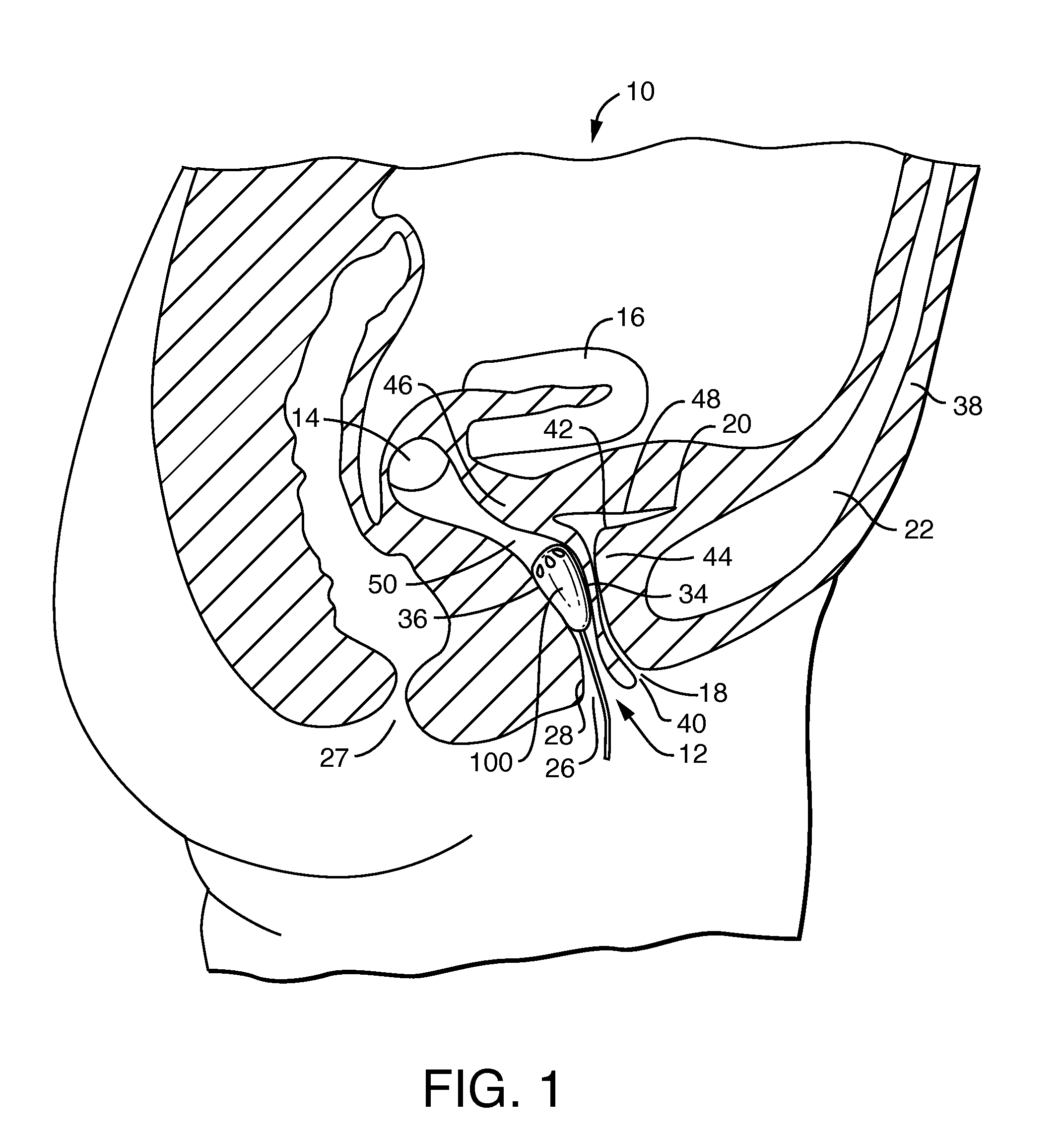 Vaginal Insert Device Having a Support Portion with Plurality of Foldable Areas