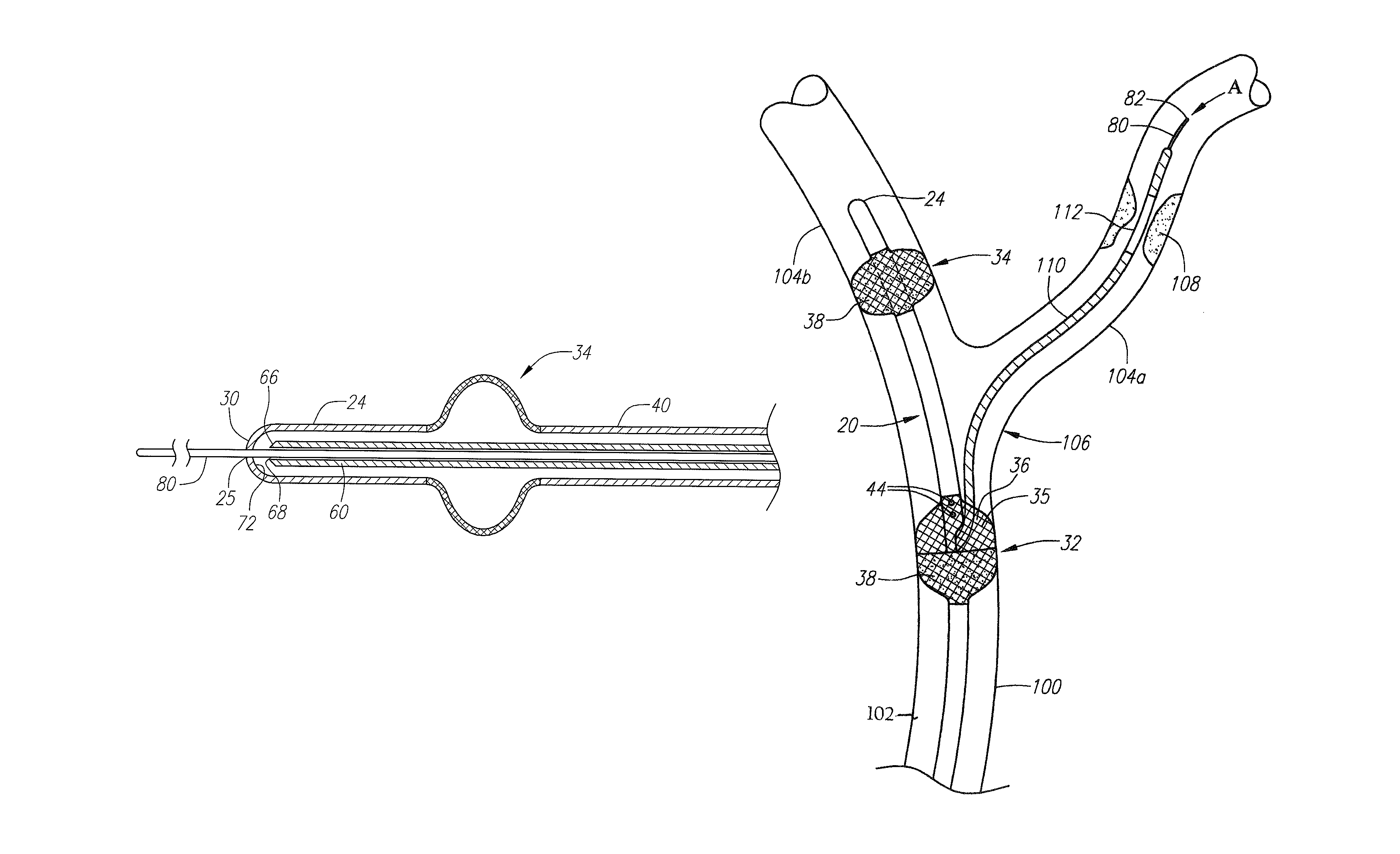 Occlusion device and method of use