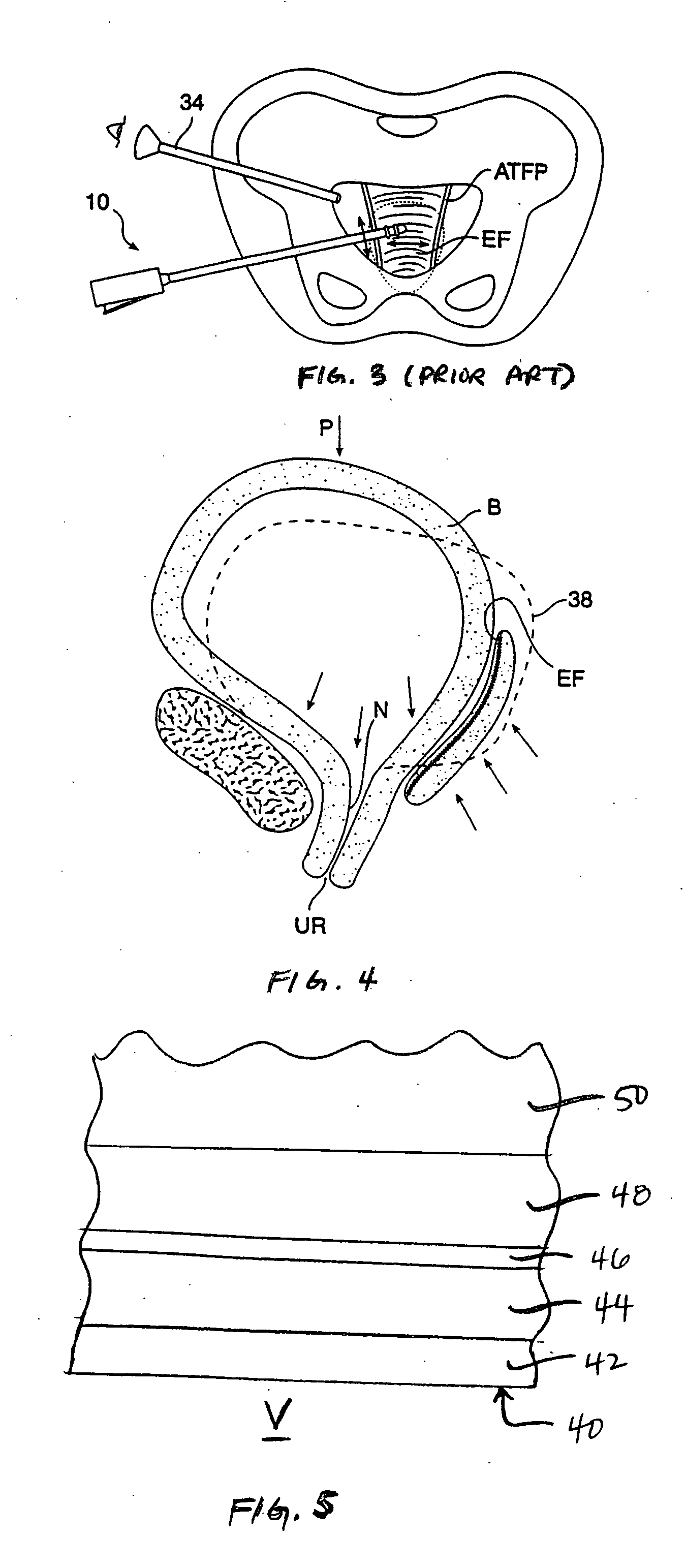 Endo-pelvic fascia penetrating heating systems and methods for incontinence treatment