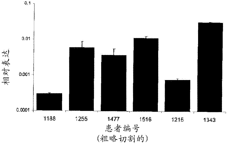 Targeting pax2 for the treatment of breast cancer