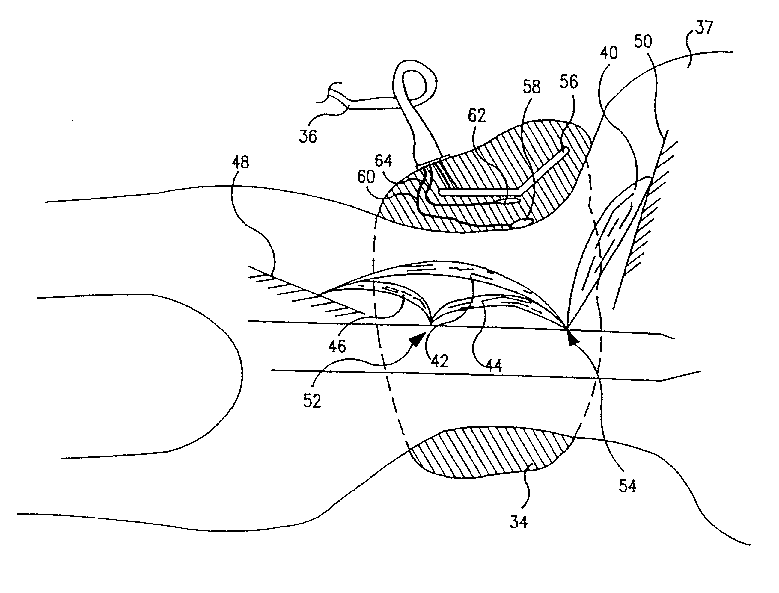 Muscle stimulating device and method for diagnosing and treating a breathing disorder