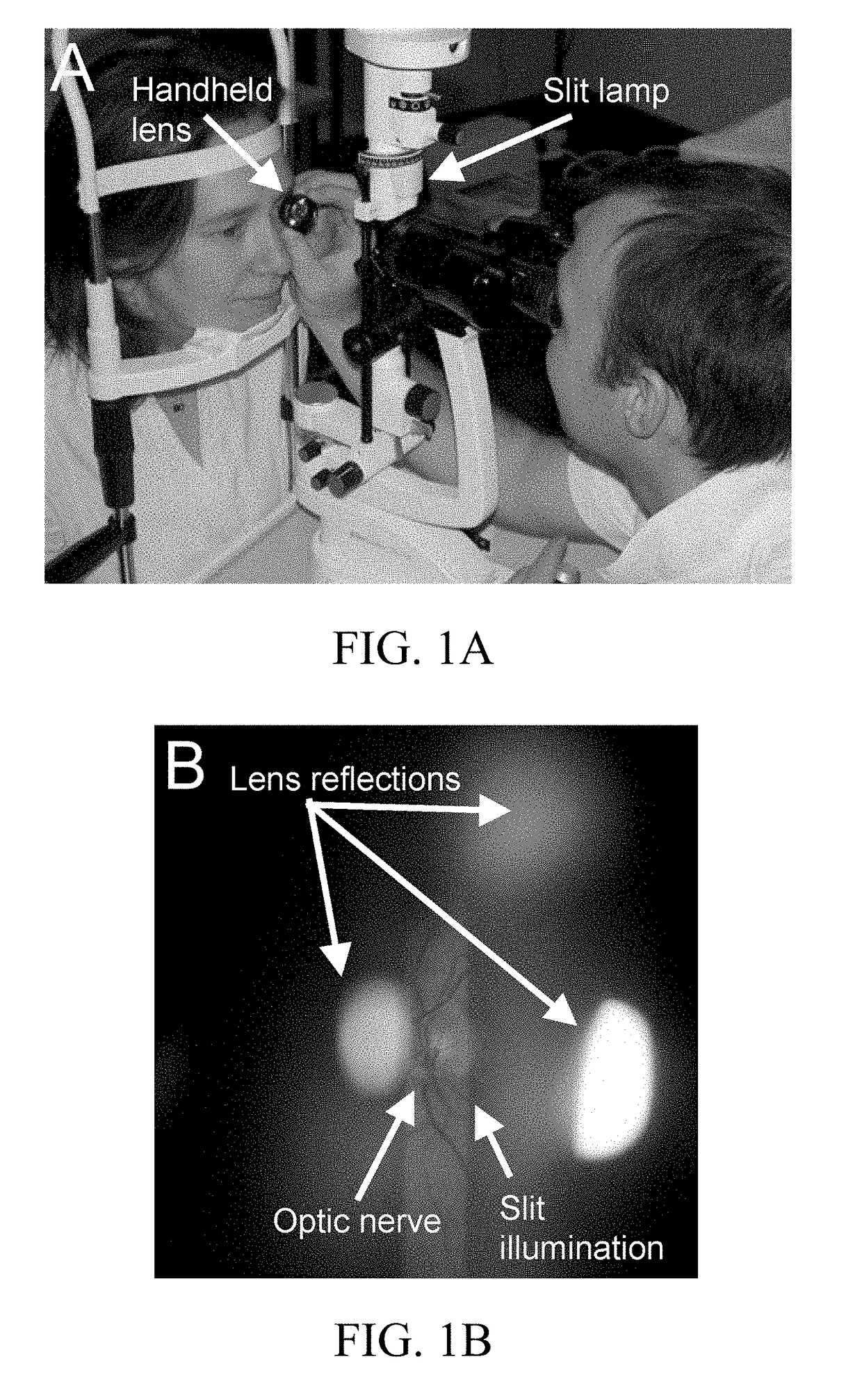 Self-Illuminated Handheld Lens for Retinal Examination and Photography and Related Method thereof