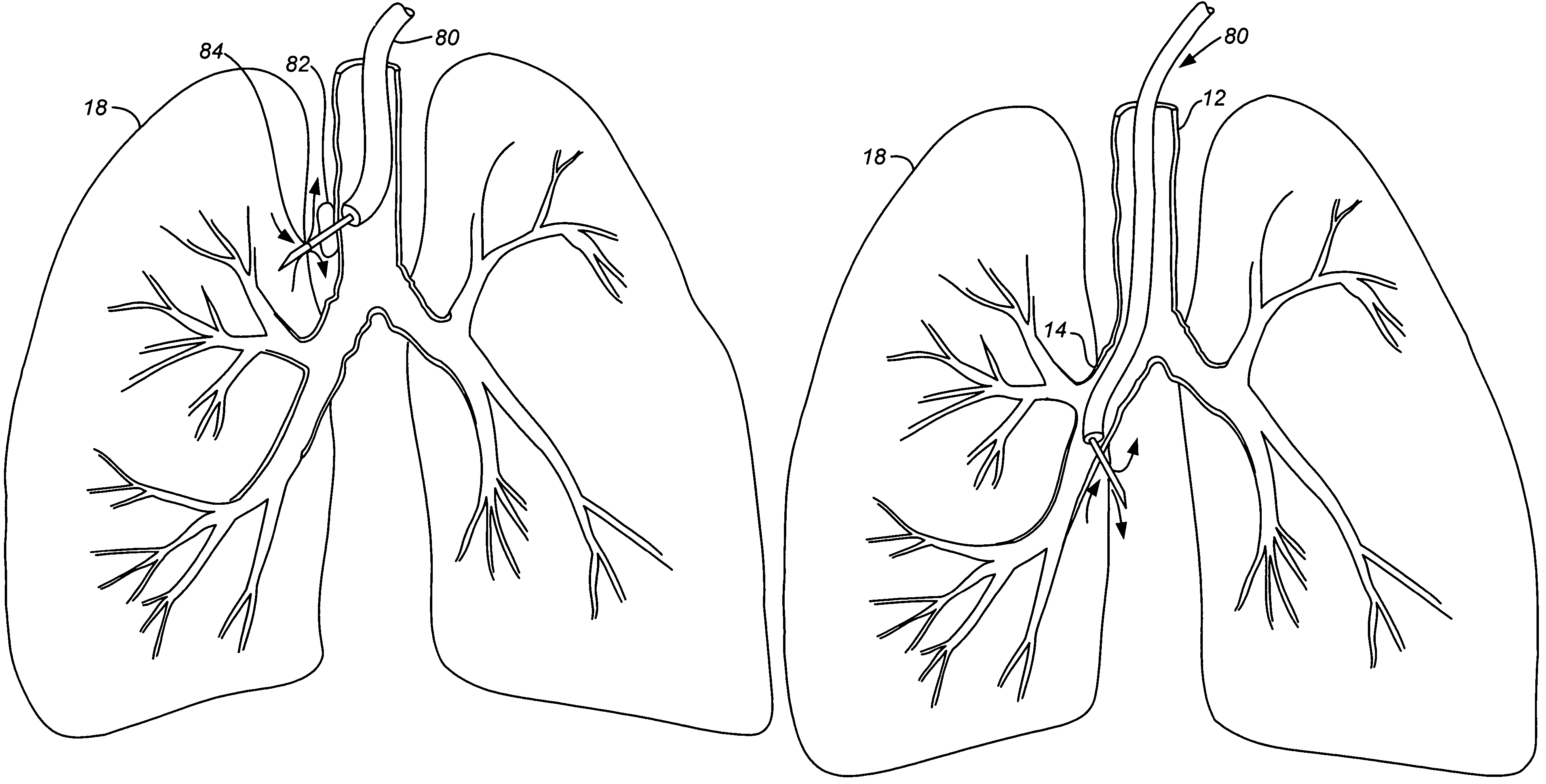 Lung device with sealing features