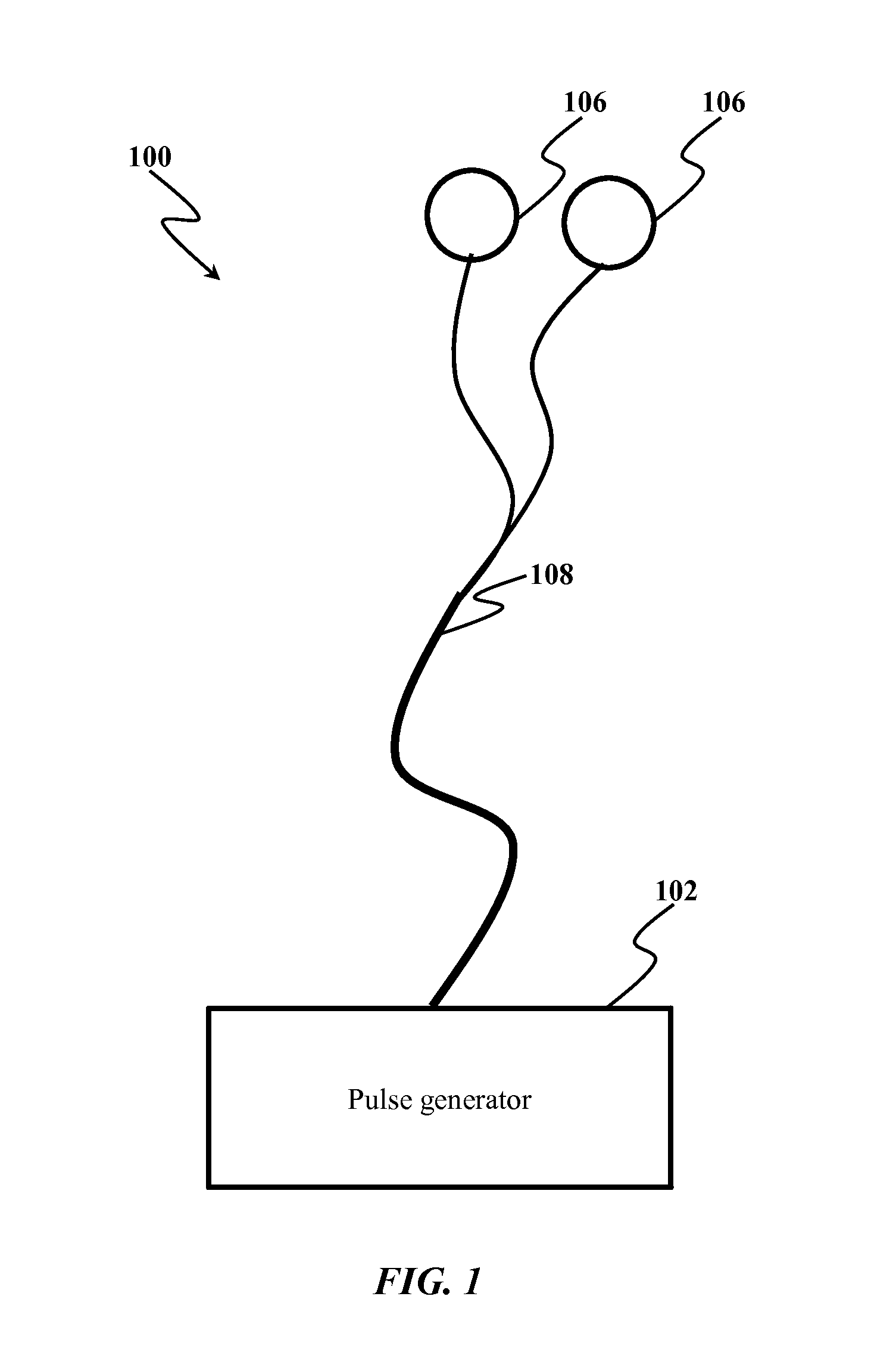System and method of treating intractable epilepsy by stimulation