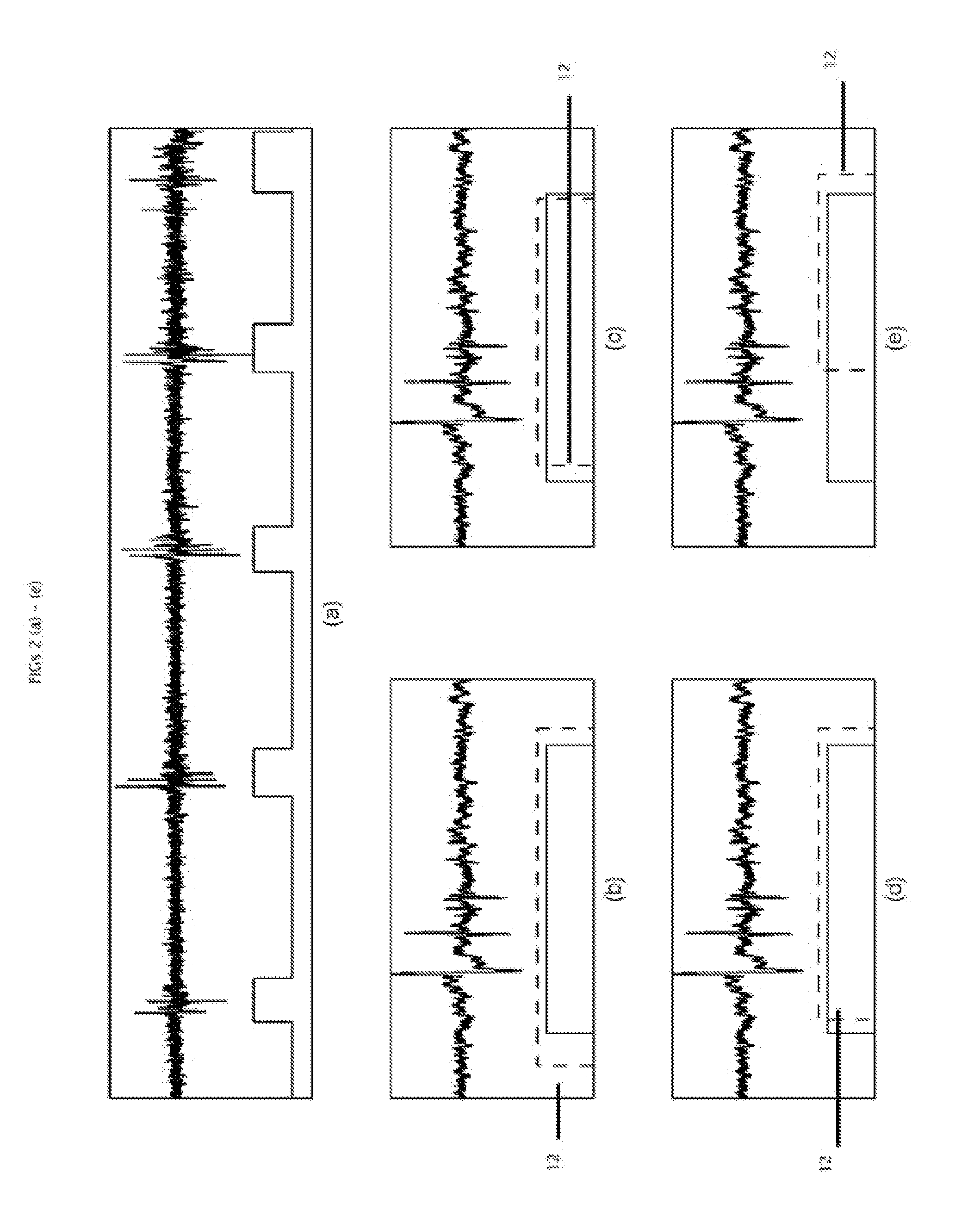 Method and system of segmentation and time duration analysis of dual-axis swallowing accelerometry signals