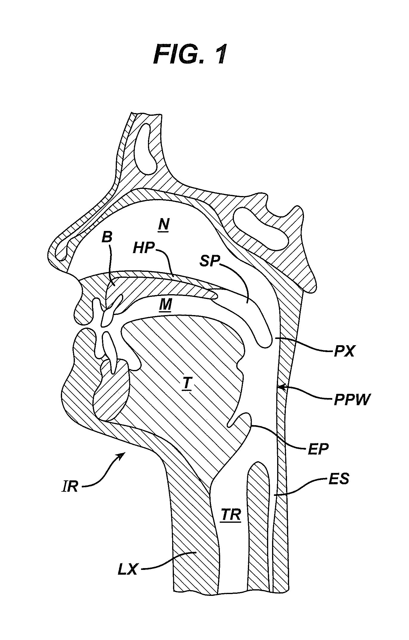 Tongue suspension device and method