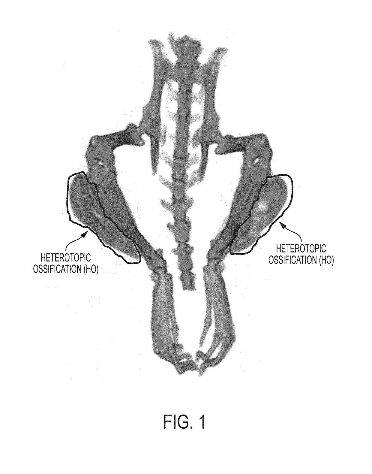 Systems and methods for automated analysis of heterotopic ossification in 3D images