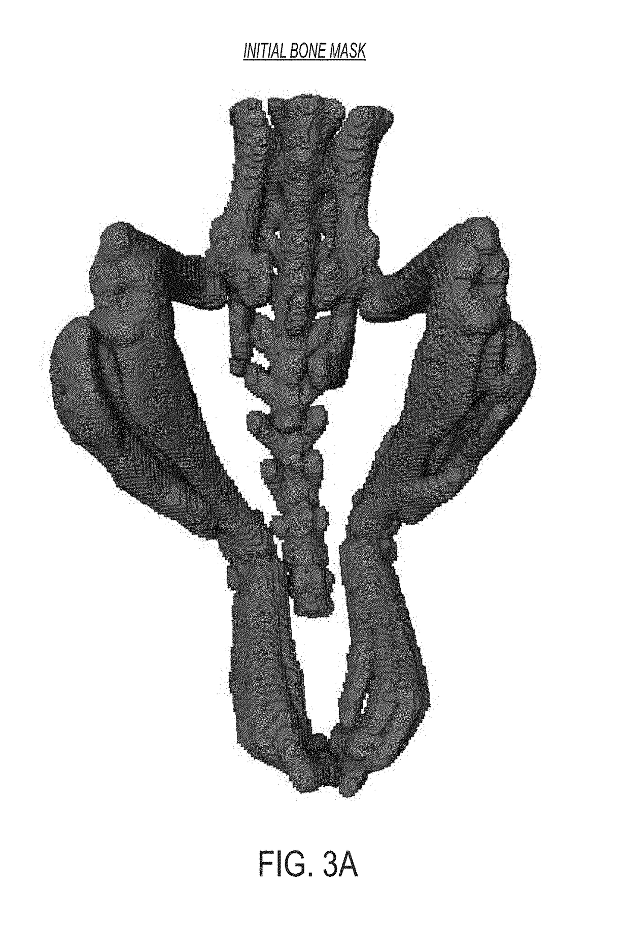 Systems and methods for automated analysis of heterotopic ossification in 3D images