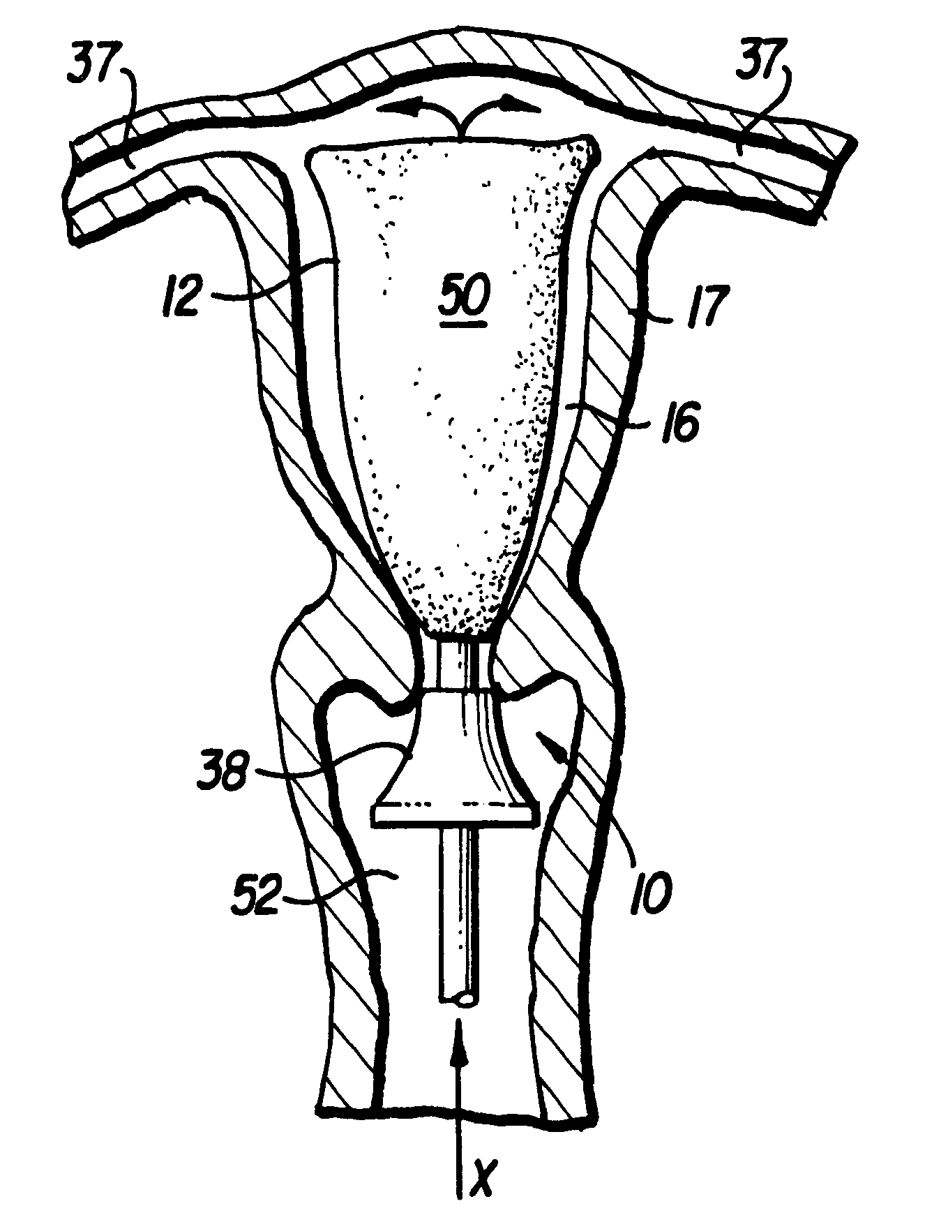 Apparatus and method for delivering and deploying an expandable body member in a uterine cavity