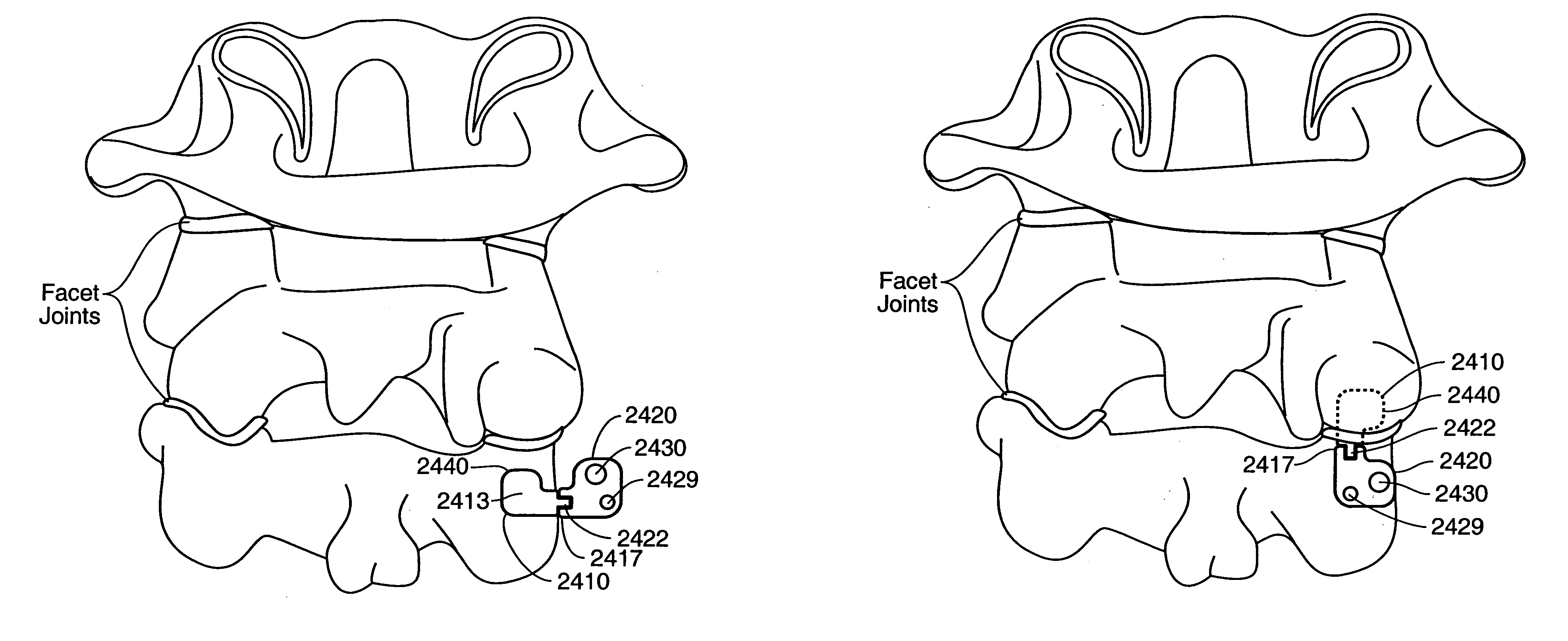 Inter-cervical facet implant and method for preserving the tissues surrounding the facet joint