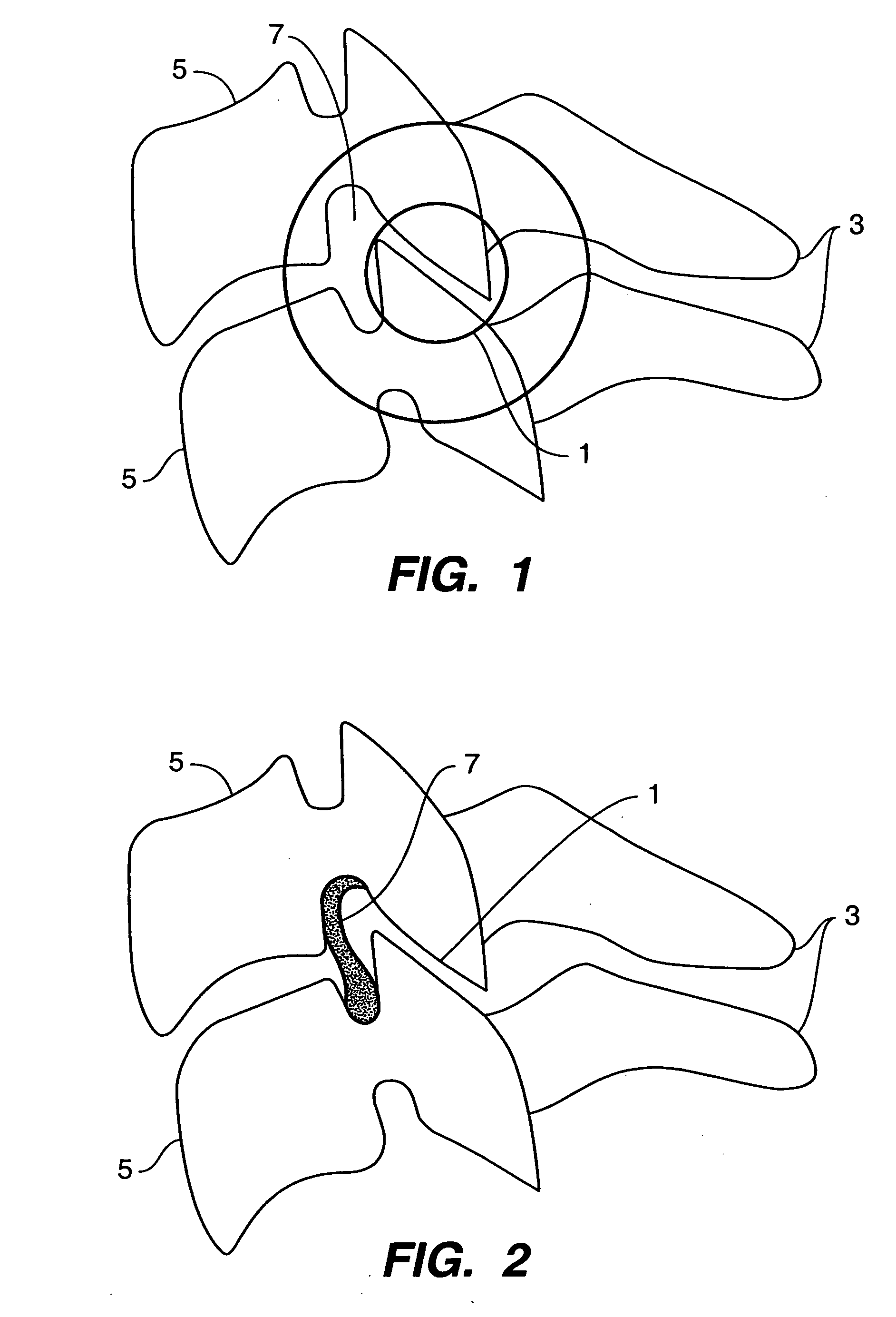 Inter-cervical facet implant and method for preserving the tissues surrounding the facet joint