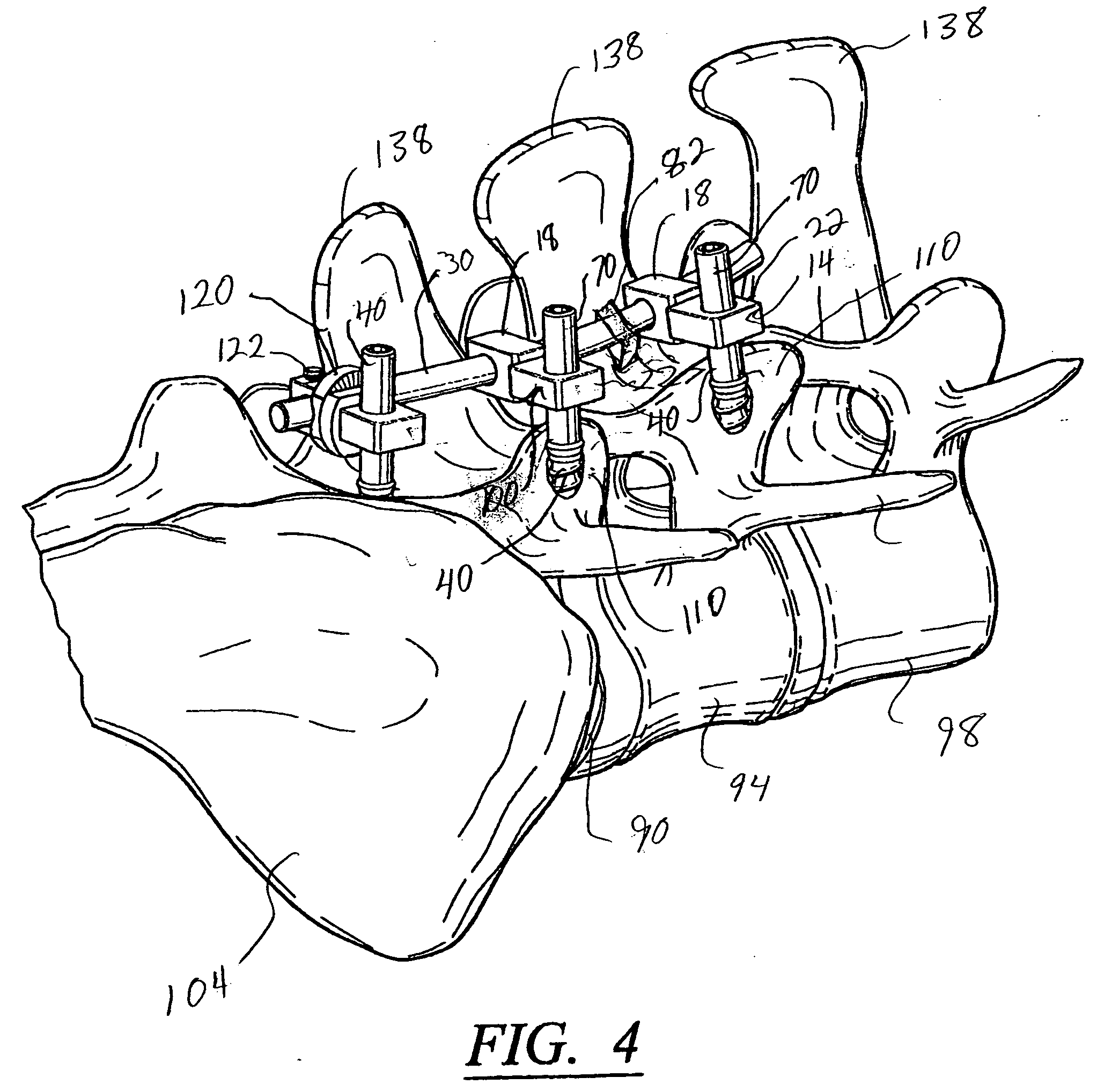 Artificial facet joint and method