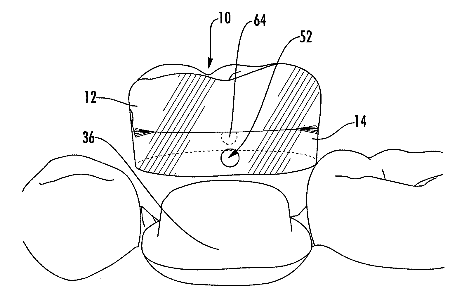 Universal dental crown and system and method of restoring a tooth using a universal dental crown