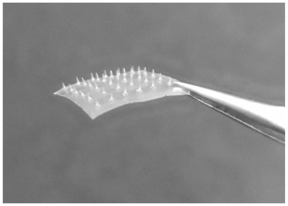 Microneedle for treating psoriasis through percutaneous delivery of lipidosome and preparation method of microneedle