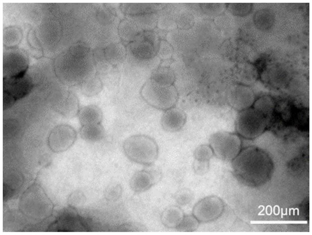 Microneedle for treating psoriasis through percutaneous delivery of lipidosome and preparation method of microneedle