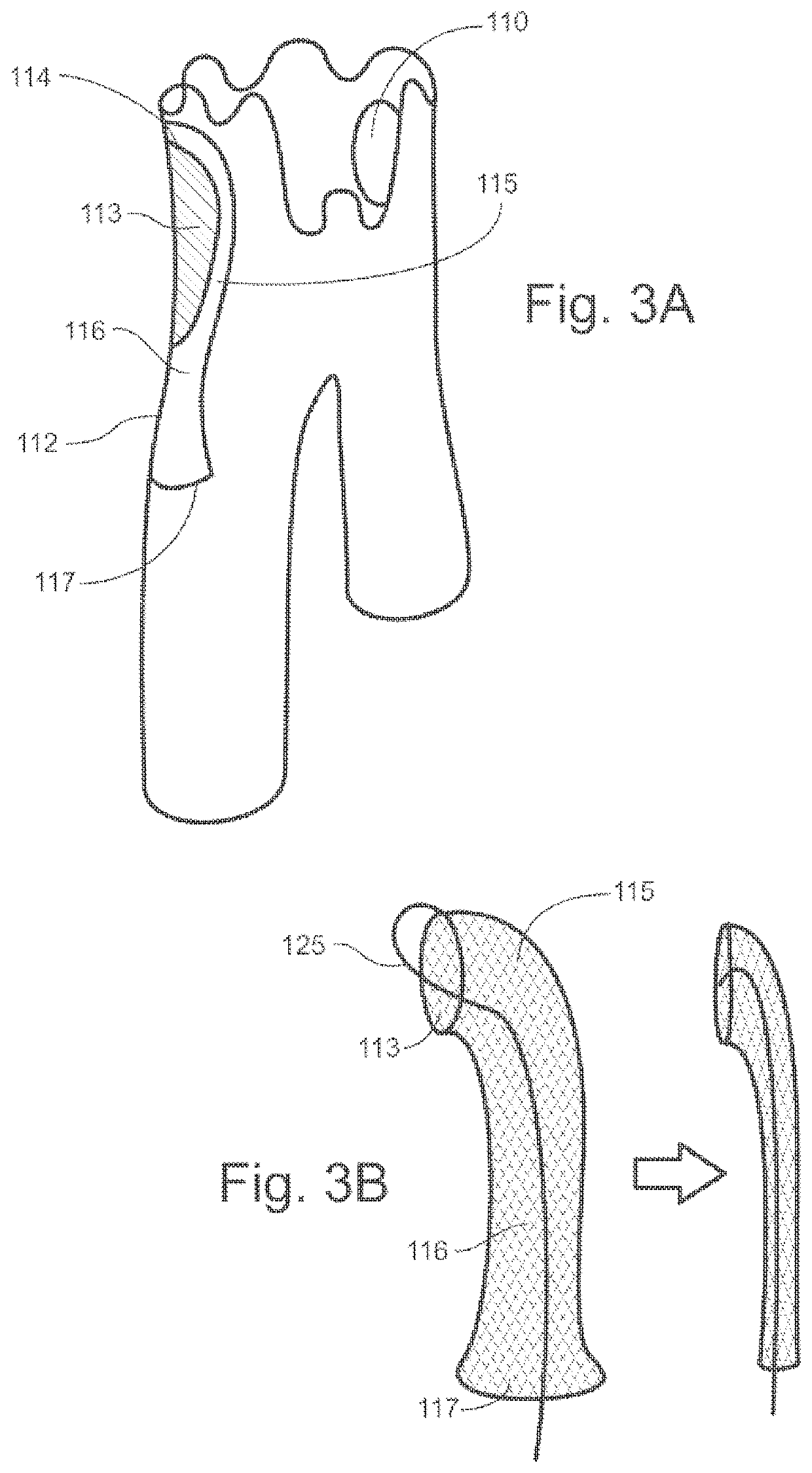 Universal endovascular grafts