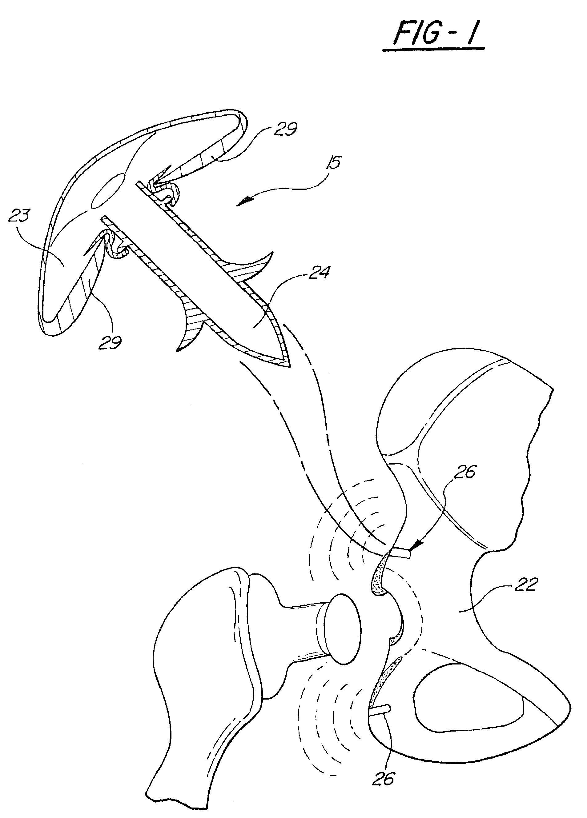 Directional-ionizing energy emitting implant