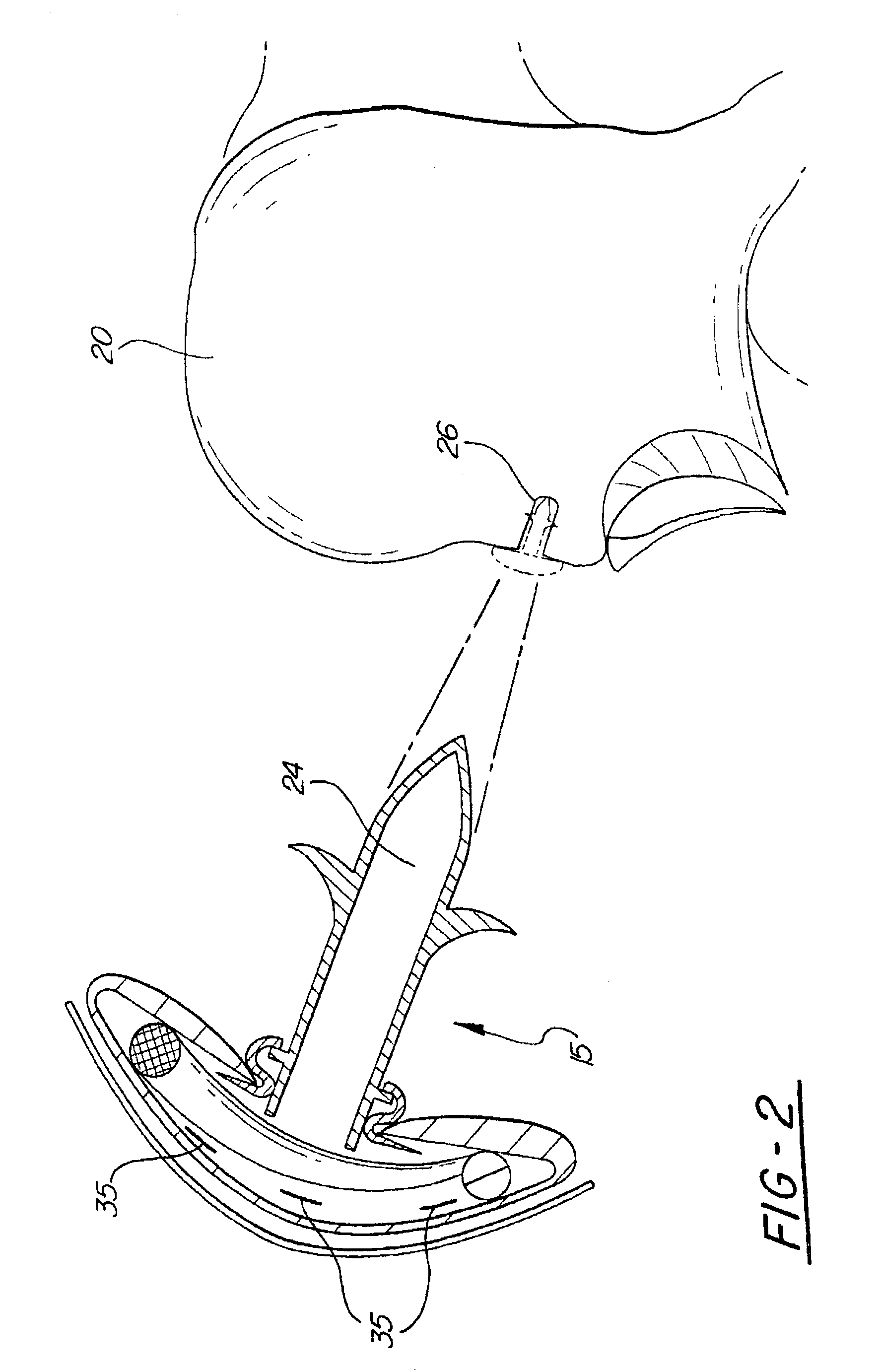 Directional-ionizing energy emitting implant