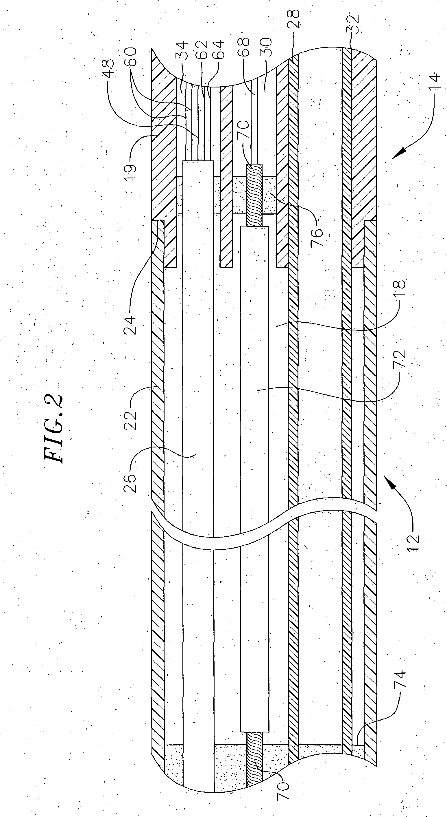 Ultrasound ablation catheter and method for its use