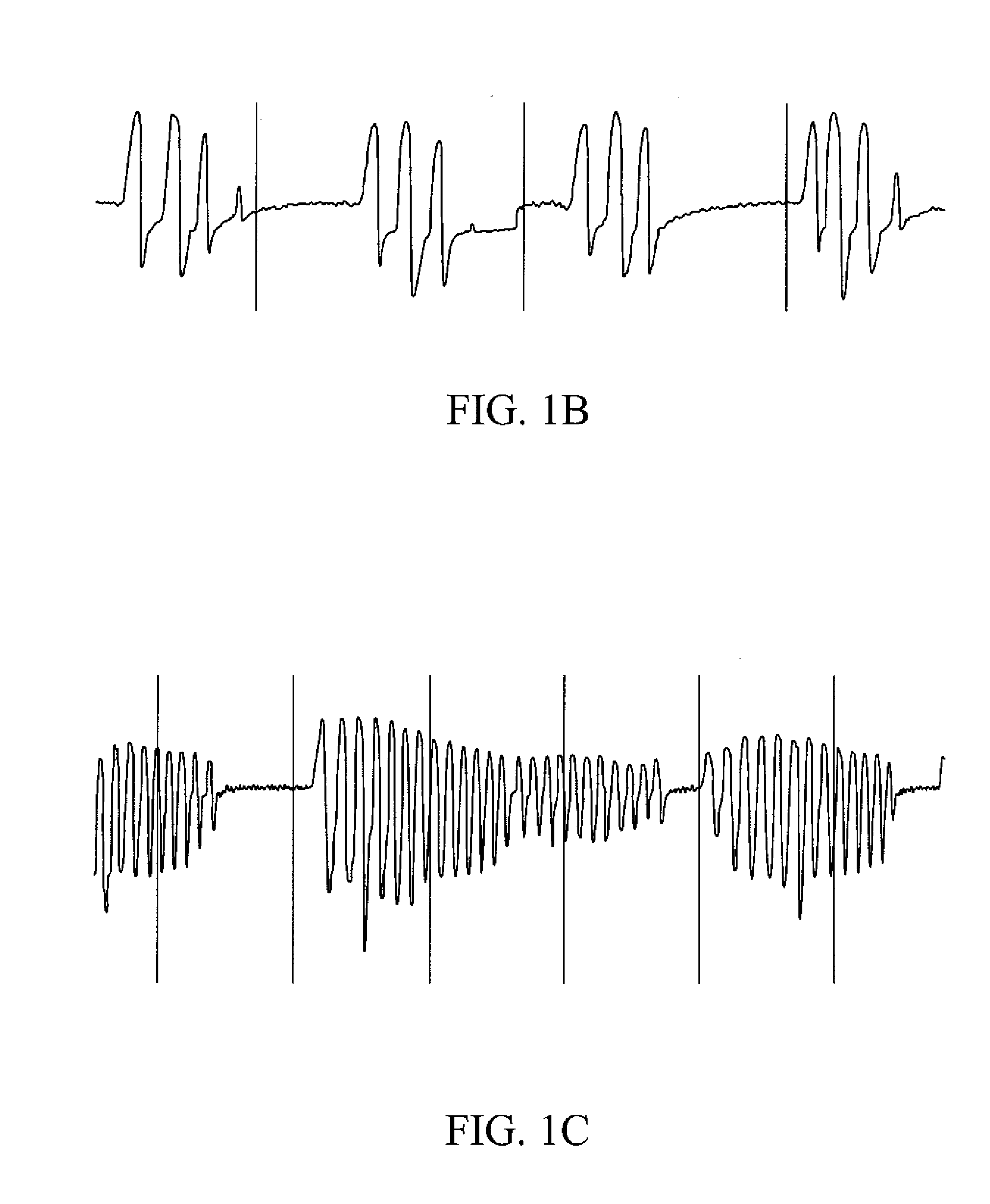 System and Method for Treating Ventilatory Instability