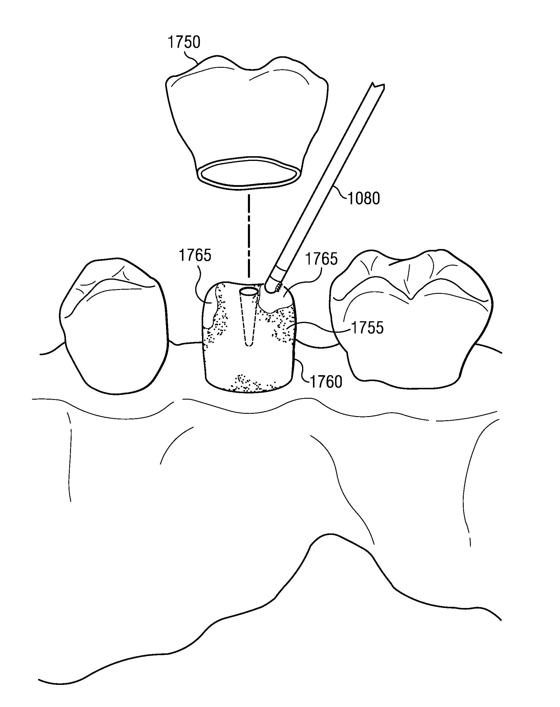 Electrosurgical system and method for treating hard body tissue