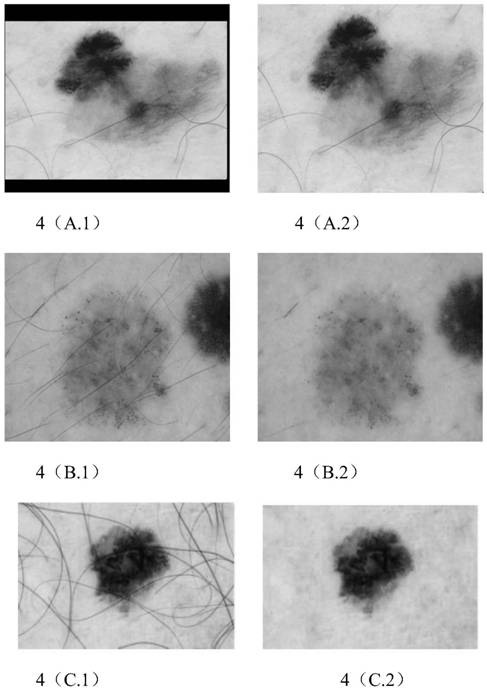 Skin disease image lesion segmentation method based on deep convolutional neural network