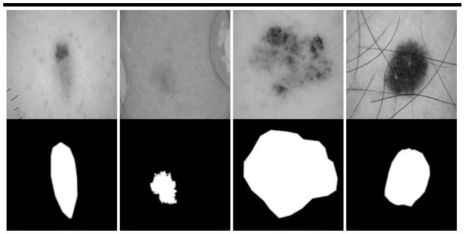 Skin disease image lesion segmentation method based on deep convolutional neural network