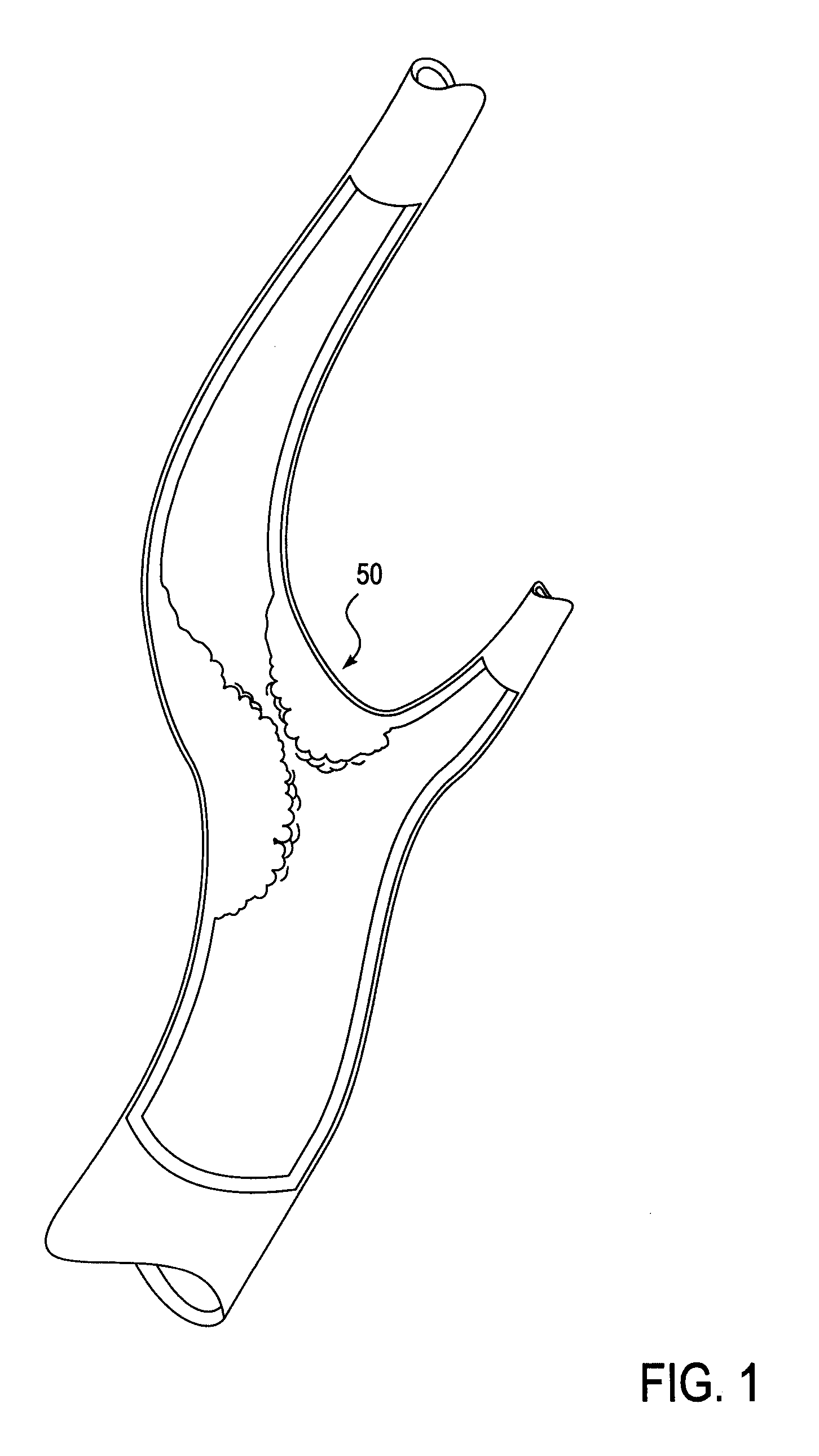 Catheter system for angioplasty and stenting with embolic protection