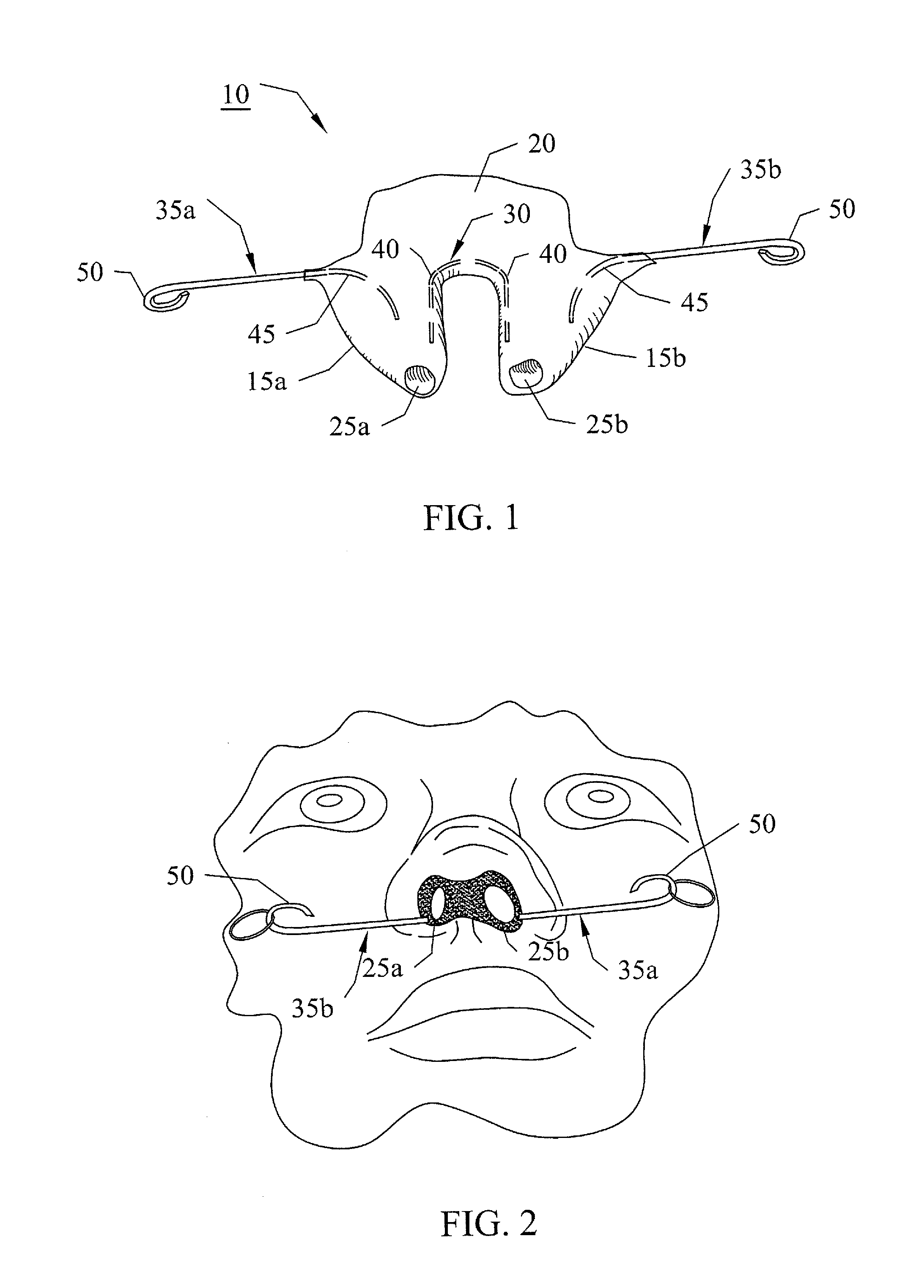 Rhinoplasty appliance and method of forming the same