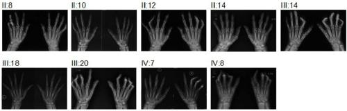 The causative gene of distal arthrogryposis and its application