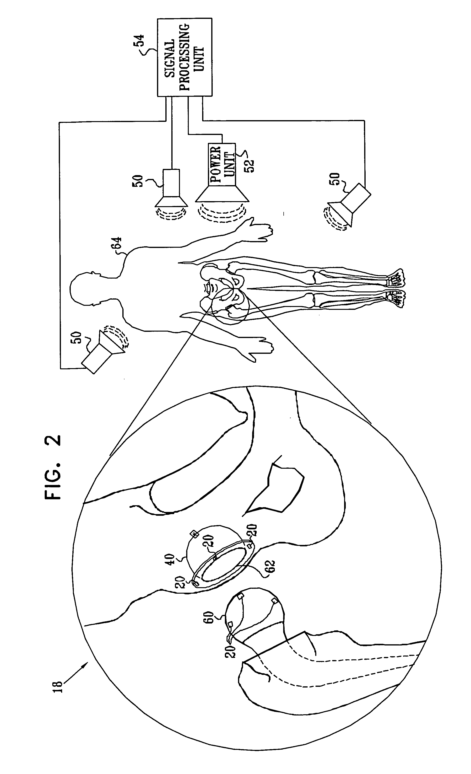 Energy transfer amplification for intrabody devices