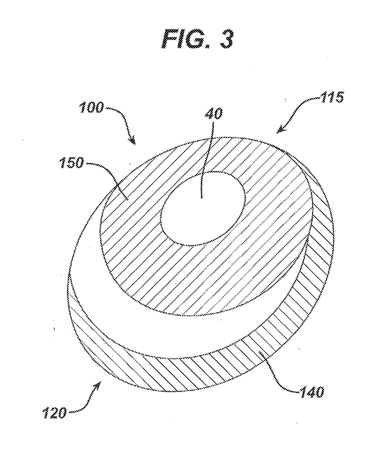 Directional Tissue Expander