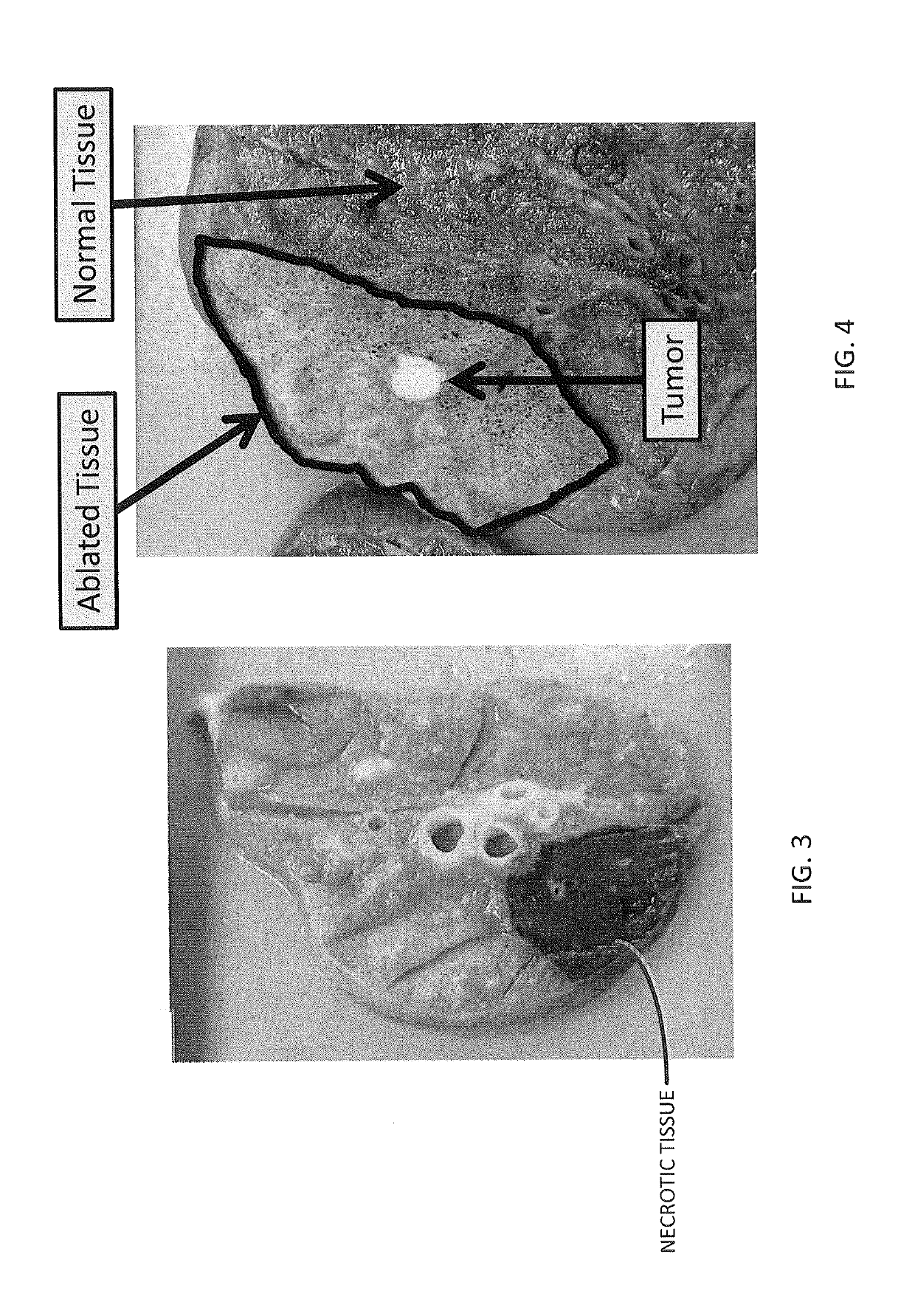 Vapor treatment of lung nodules and tumors