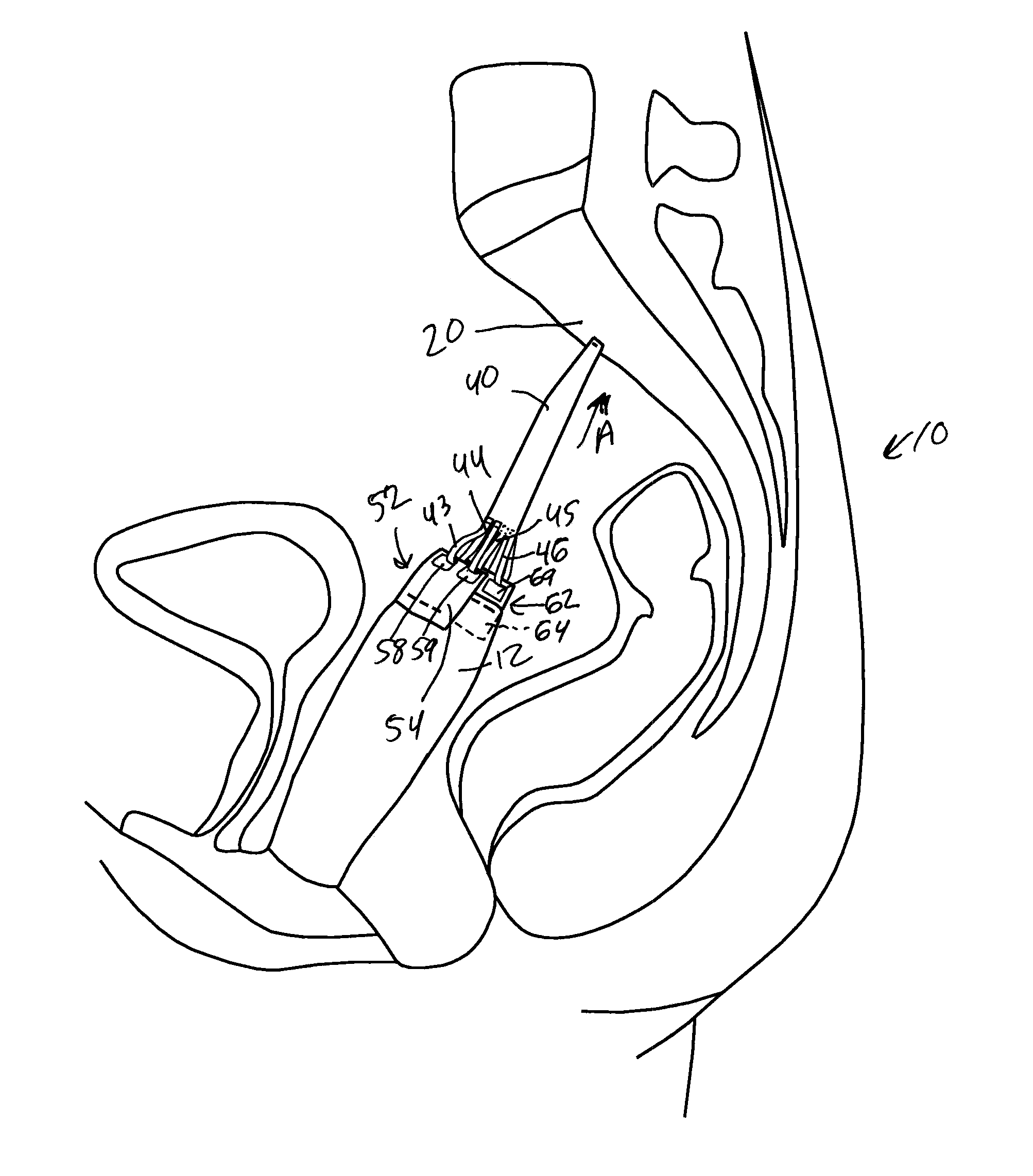 Vaginal vault suspension device and method