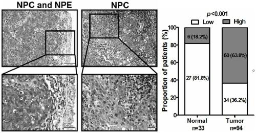 Application of reagents that interfere with the expression of long-chain non-coding RNA PVT1 in the preparation of radiosensitizers for nasopharyngeal carcinoma