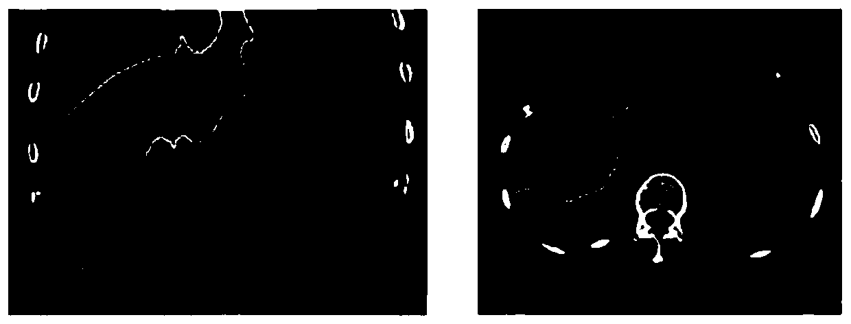 Automatic liver segmentation method based on deformation model of CT image