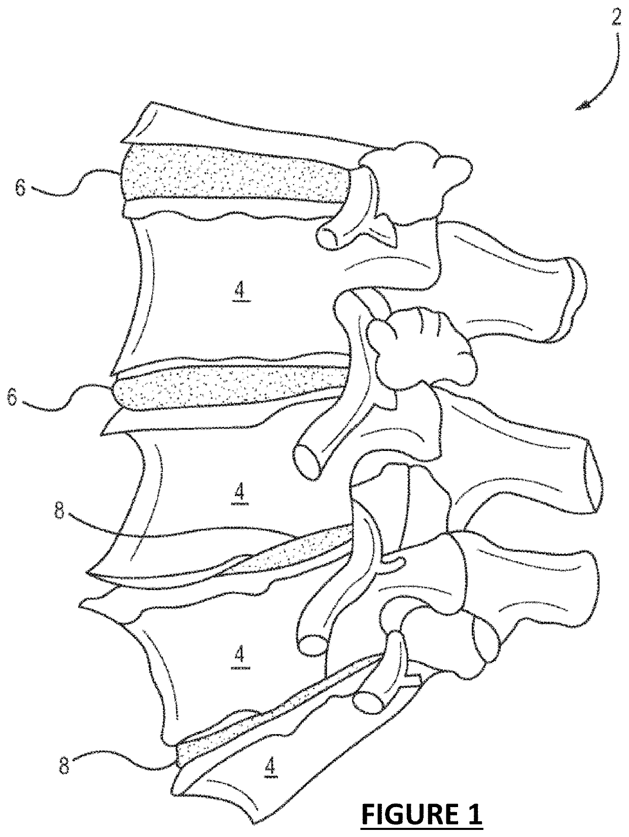 Vertebral body reaming method