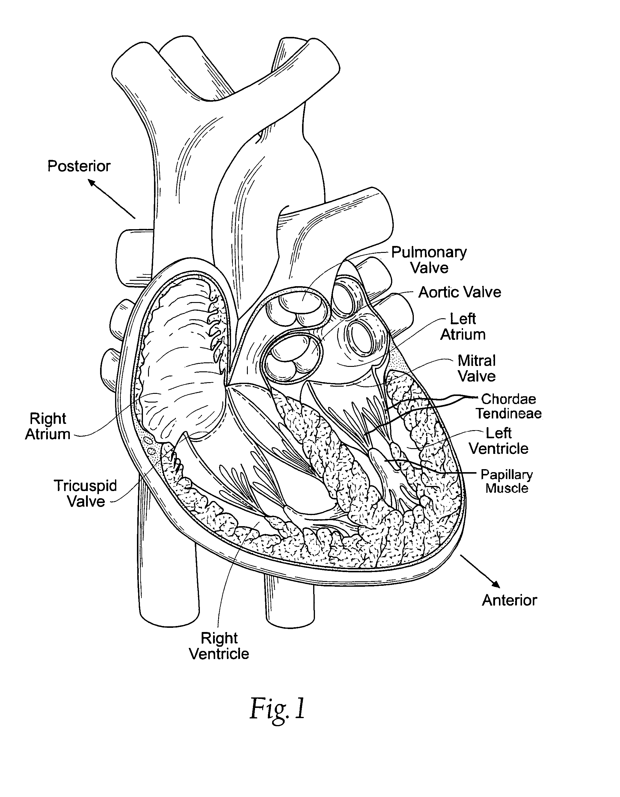 Quick-connect prosthetic heart valve and methods