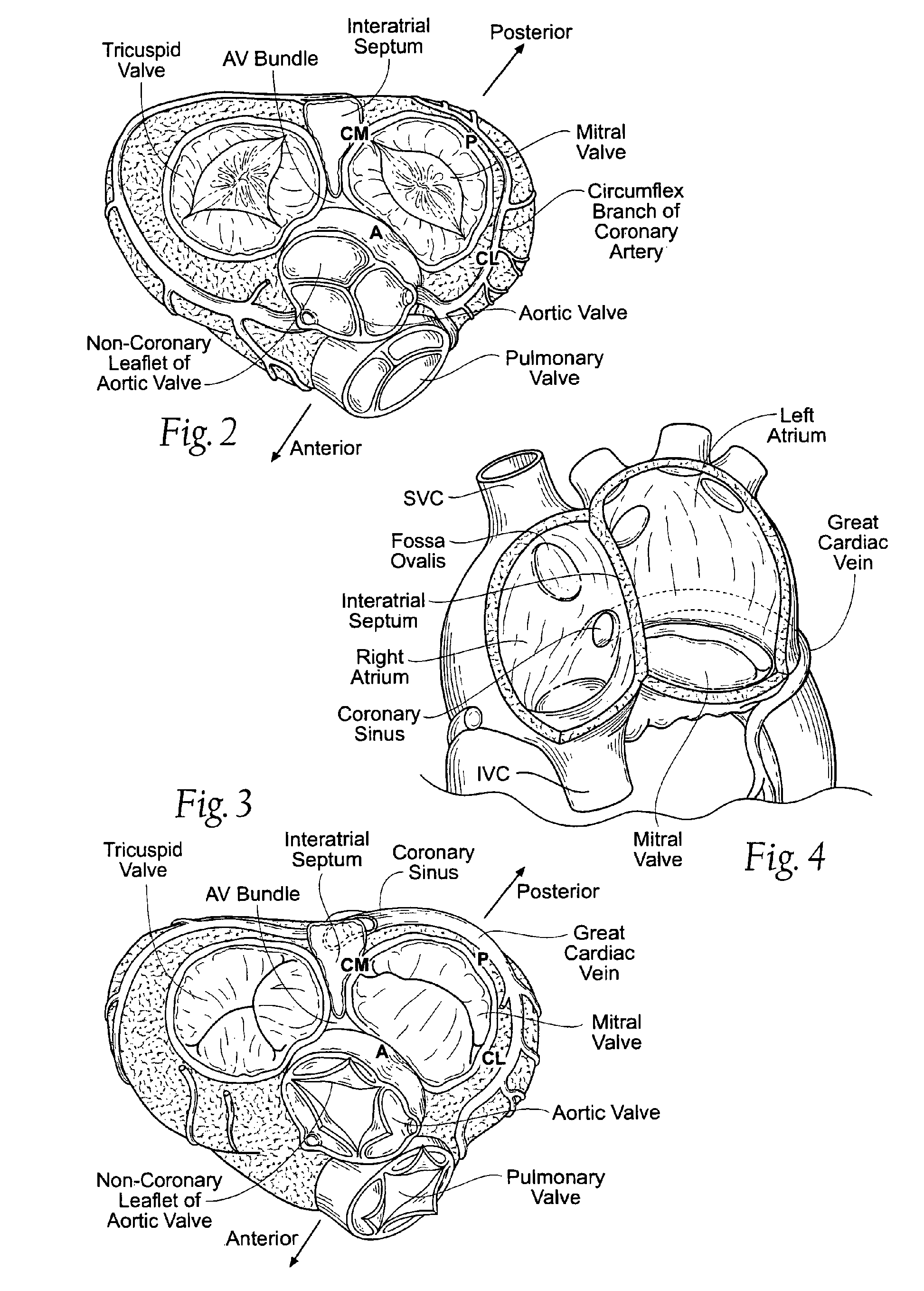 Quick-connect prosthetic heart valve and methods