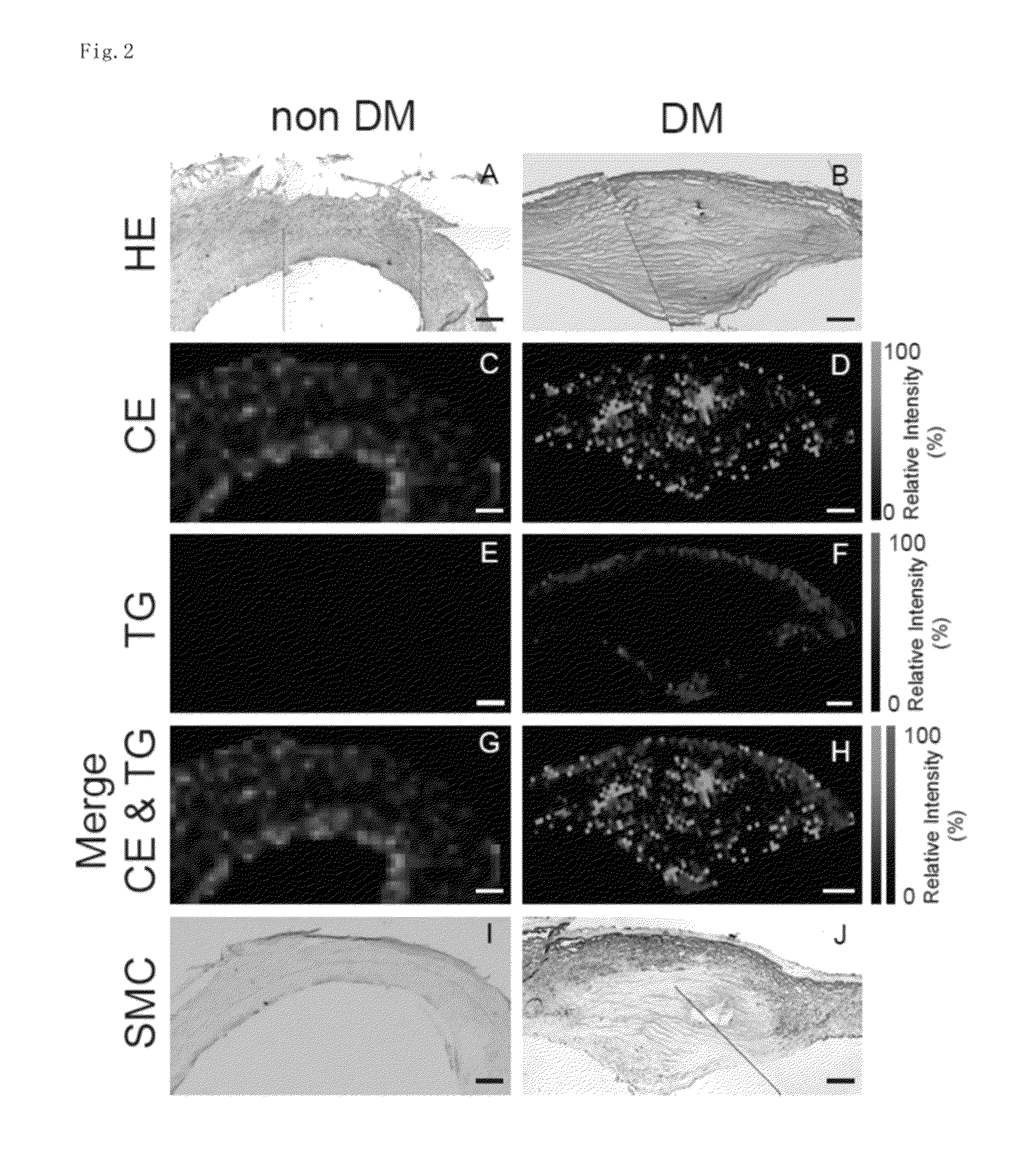 Prophylactic and/or therapeutic agent for cardiovascular complications of diabetes