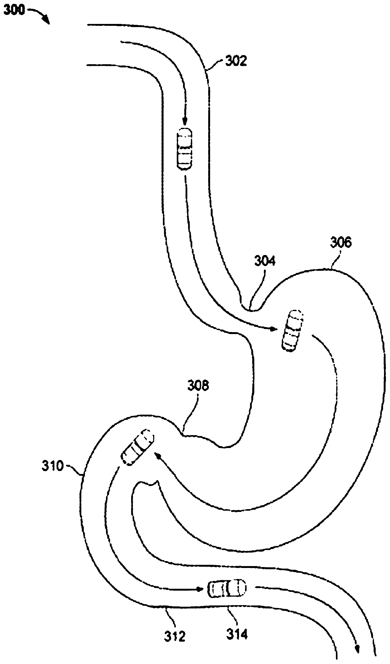 Treatment of a disease of the gastrointestinal tract with a TNF inhibitor