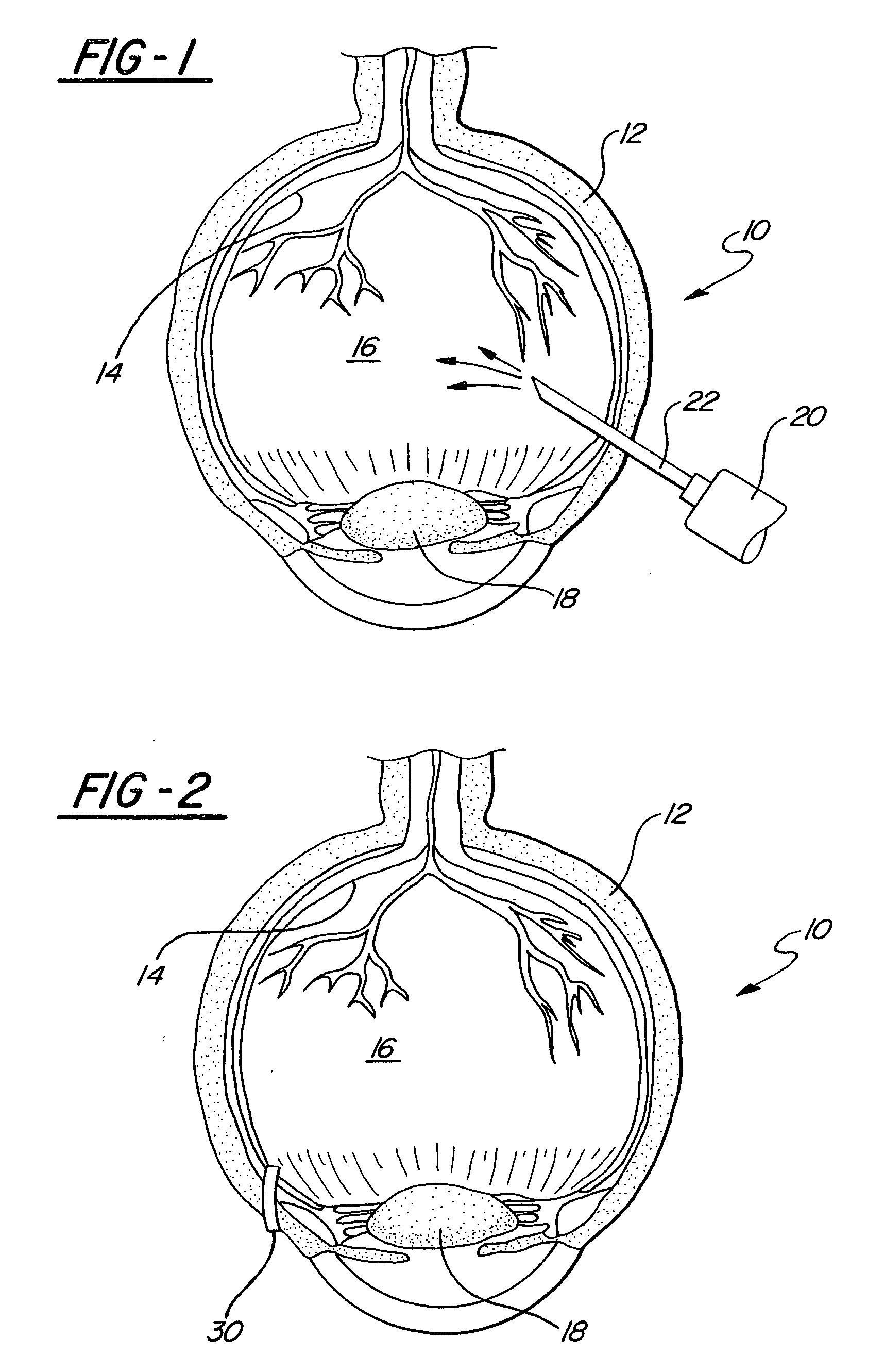 Method for creating a separation of posterior cortical vitreous from the retina of the eye