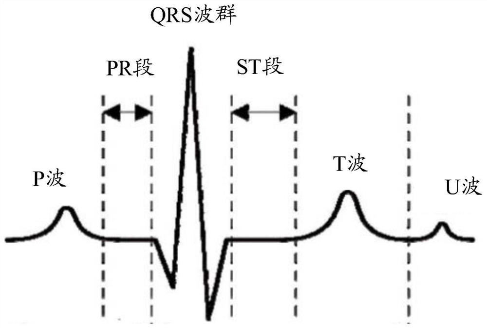 Training method for noise reduction autoencoder, noise reduction method for ECG signal, and related devices and equipment