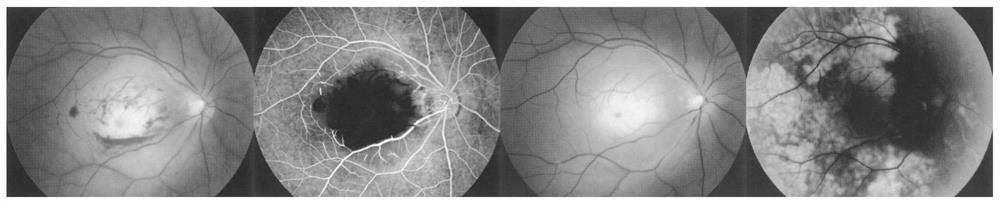 Eye fundus image blood vessel segmentation method and system based on self-supervised learning