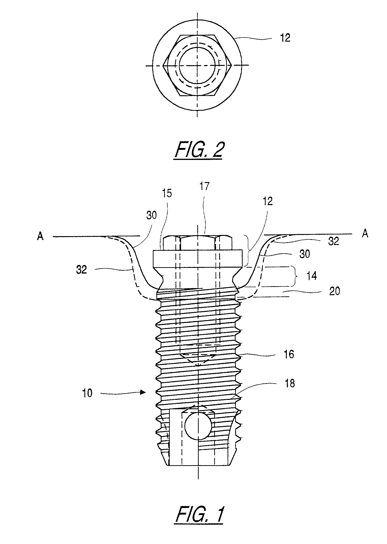 Infection-blocking dental implant