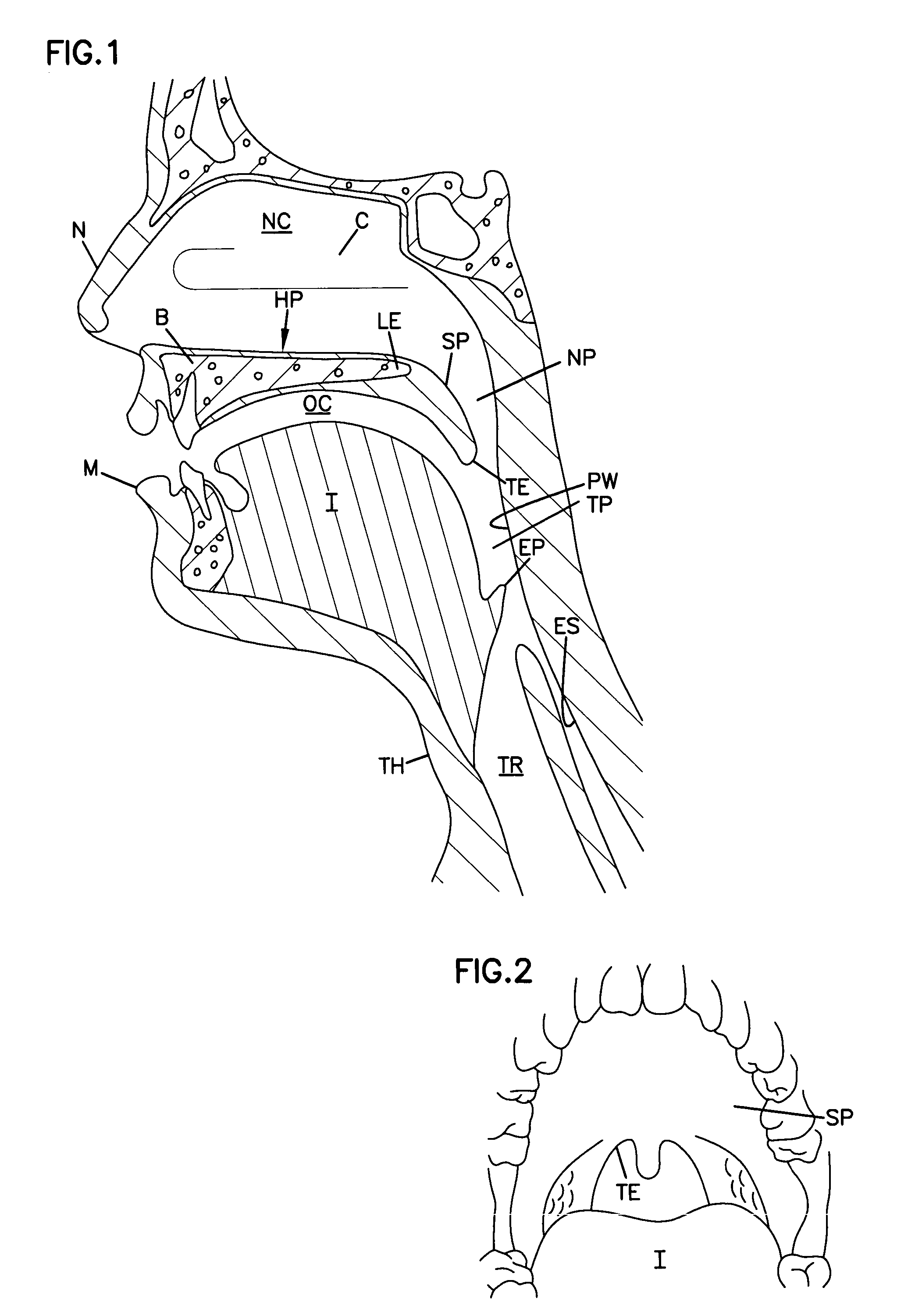 Airway implant and delivery tool and kit