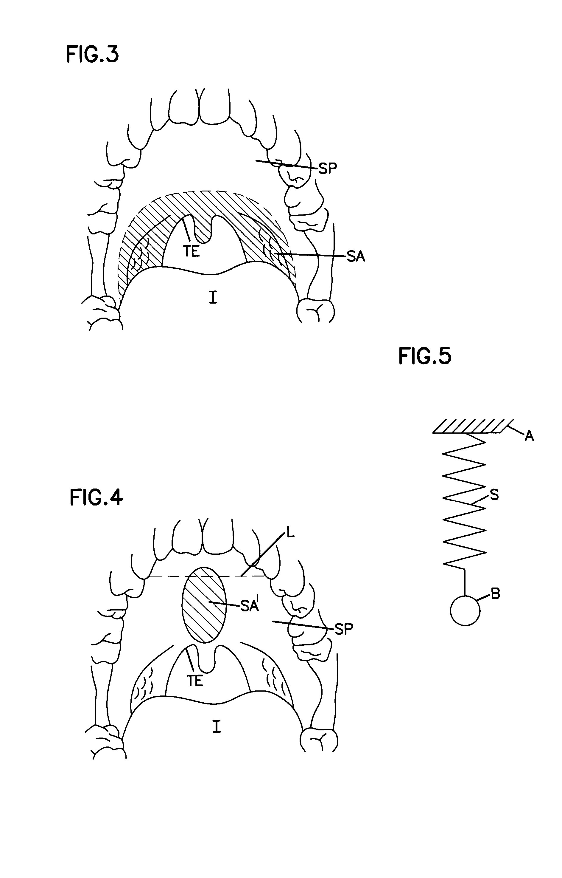 Airway implant and delivery tool and kit
