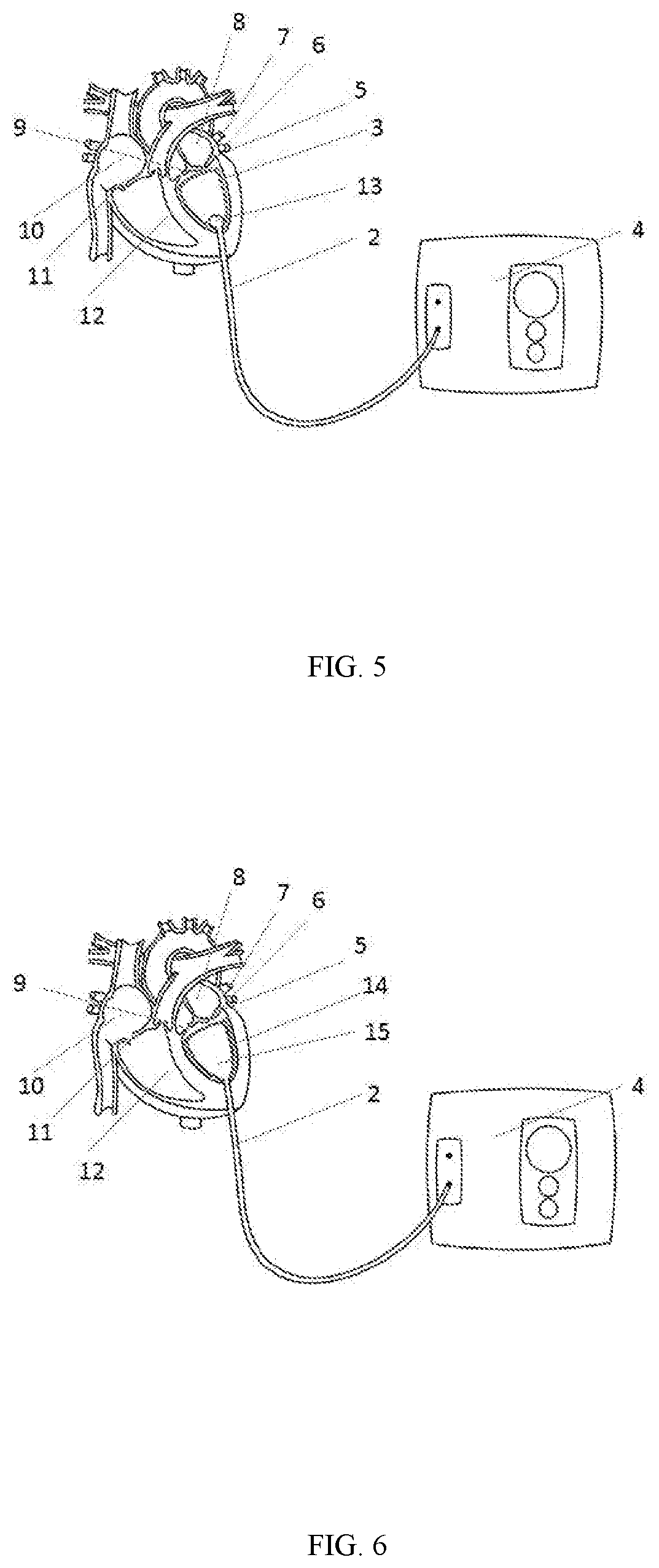 Implantable ventricular assist device