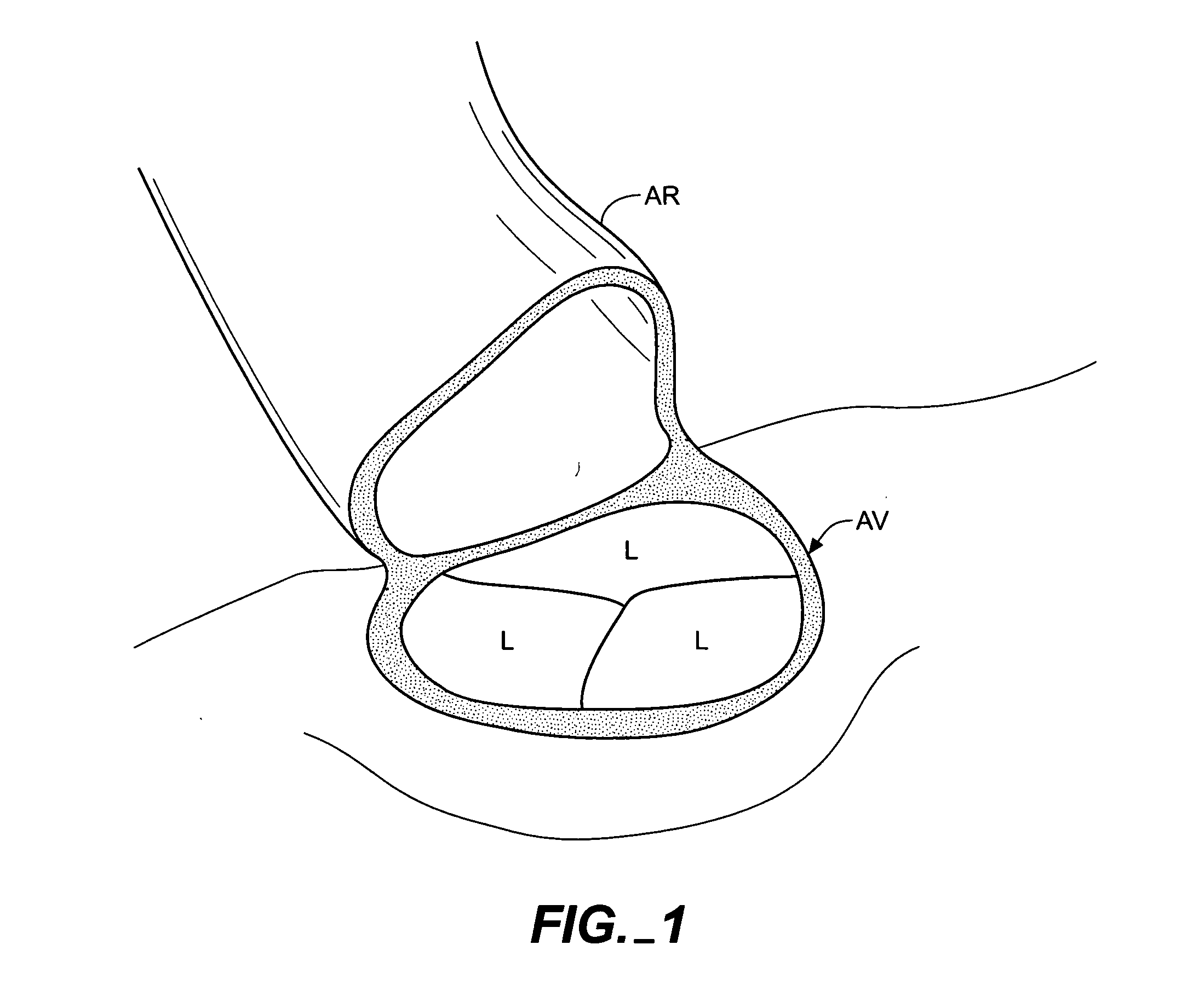 Apparatus and methods for minimally invasive valve surgery