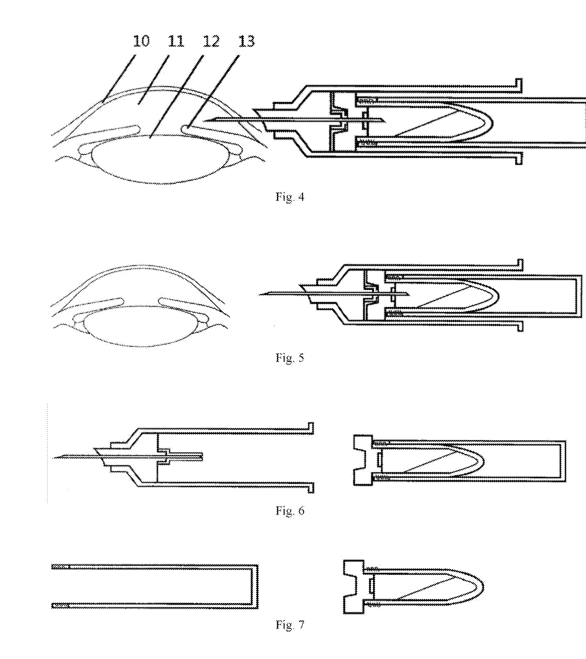 A Disposable Negative-pressure Anterior Chamber Paracentesis syringe